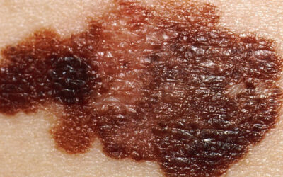 Skin Cancer Signs Symptoms: Types and Key Indicators