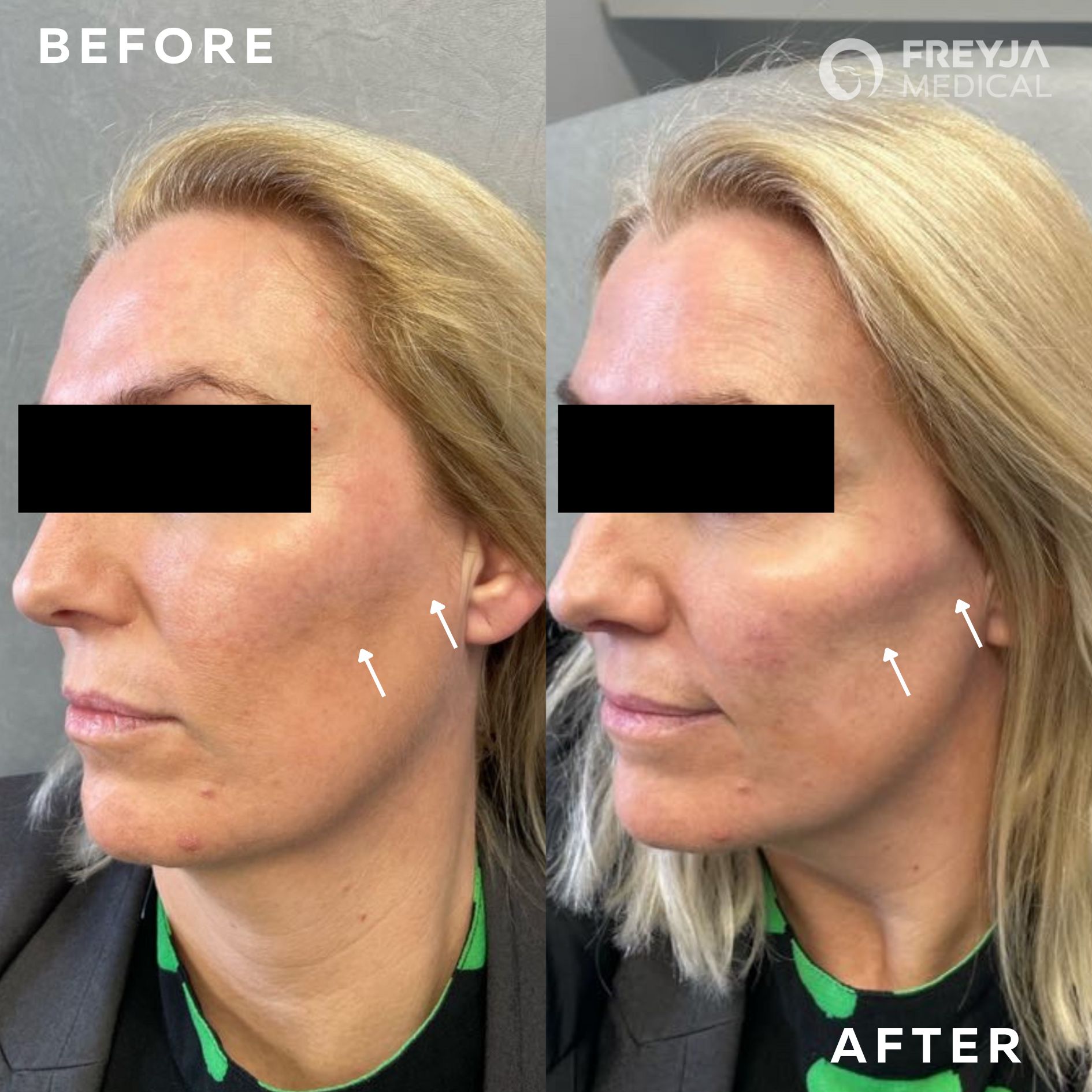 Dermal Fillers at Freyja Medical: Before and After Image