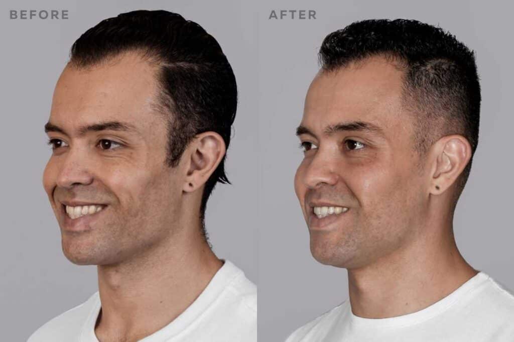 Sculptra Before and After Image
