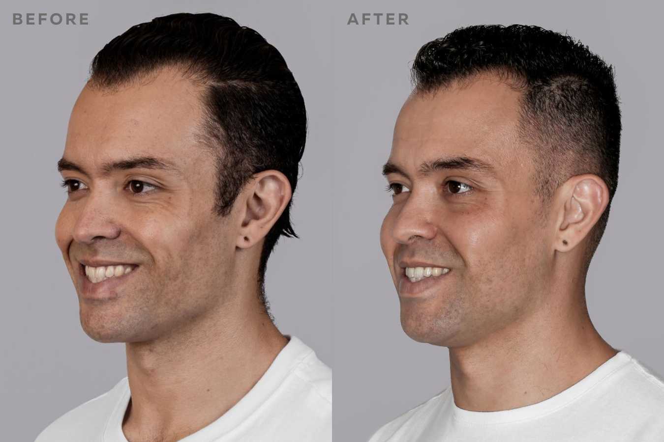 Sculptra Before and After Image