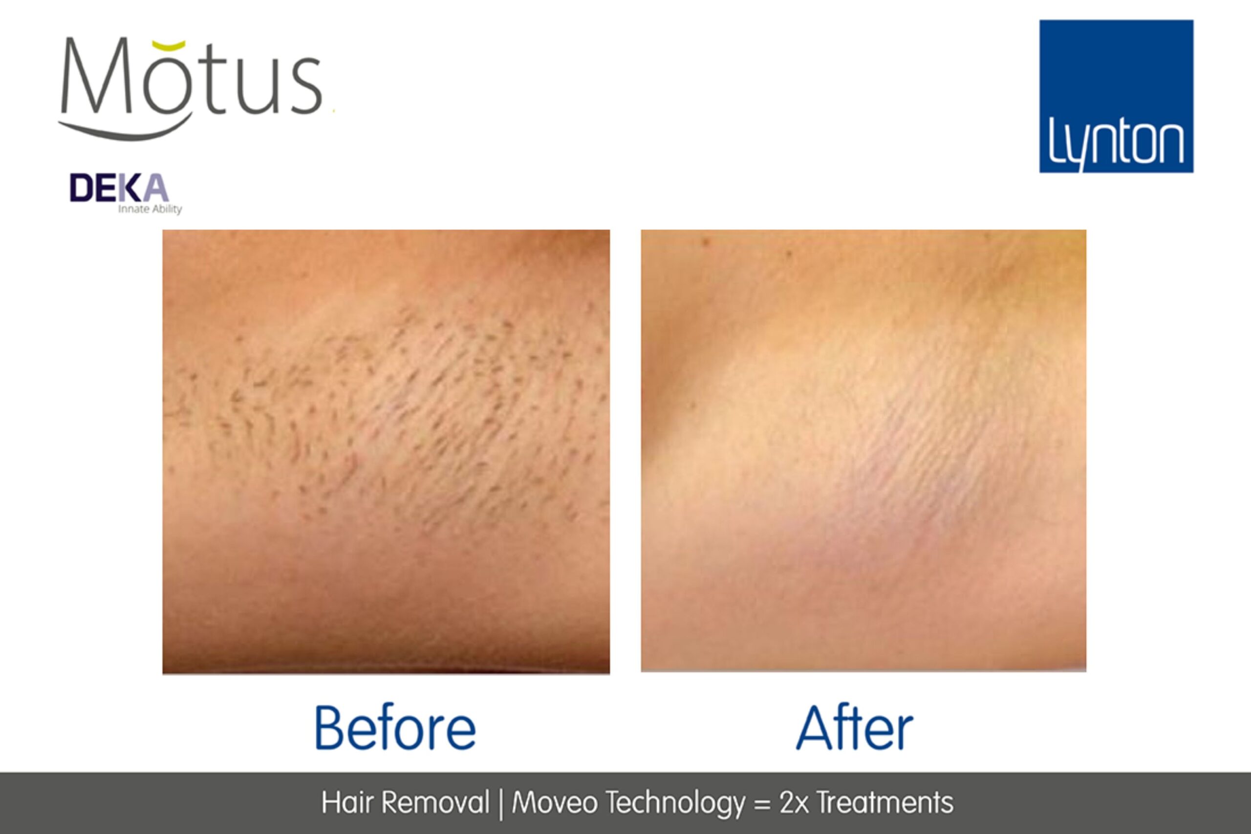 Underarm Laser Hair Removal with the Motus AY at Freyja Medical: Before and After Image