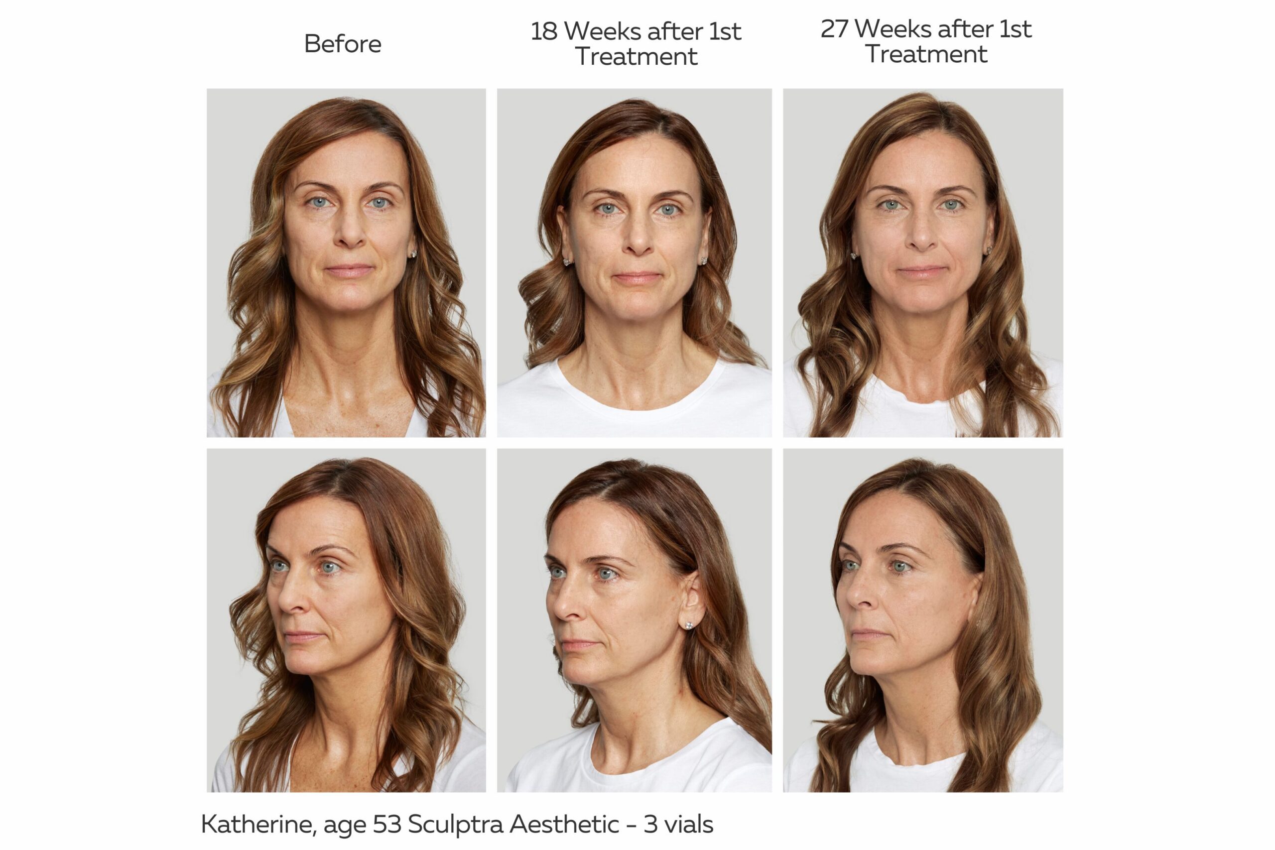 Sculptra Before and After Images