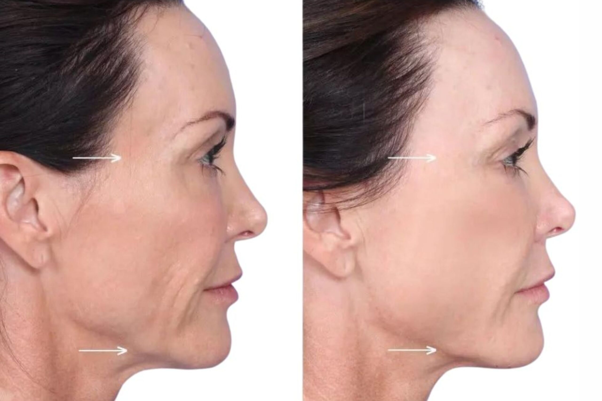 Sculptra Before and After Image