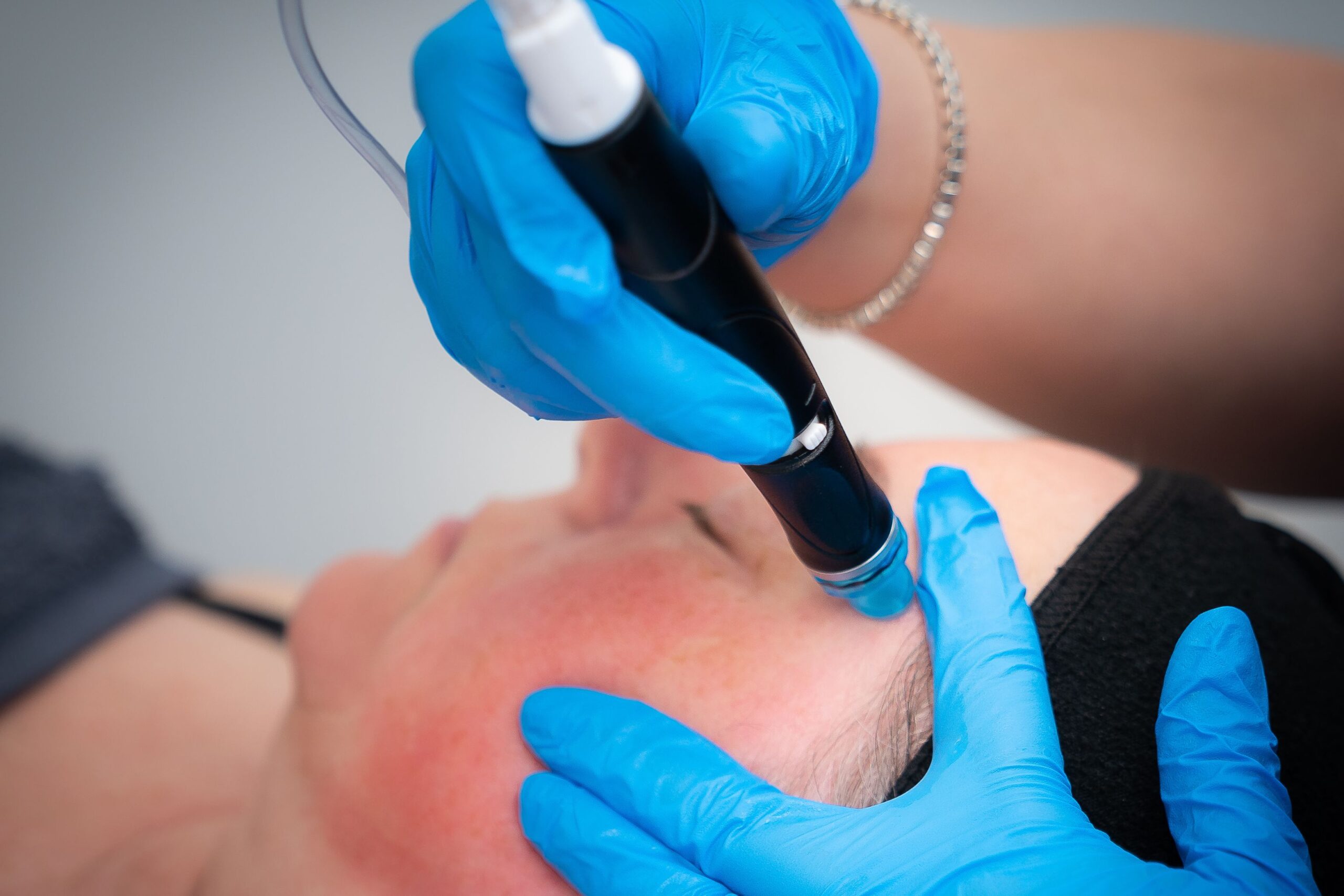 Hydrafacial treatment performed by therapist Hattie, at Freyja Medical Nantwich. 20% Off Facials for a limited time only