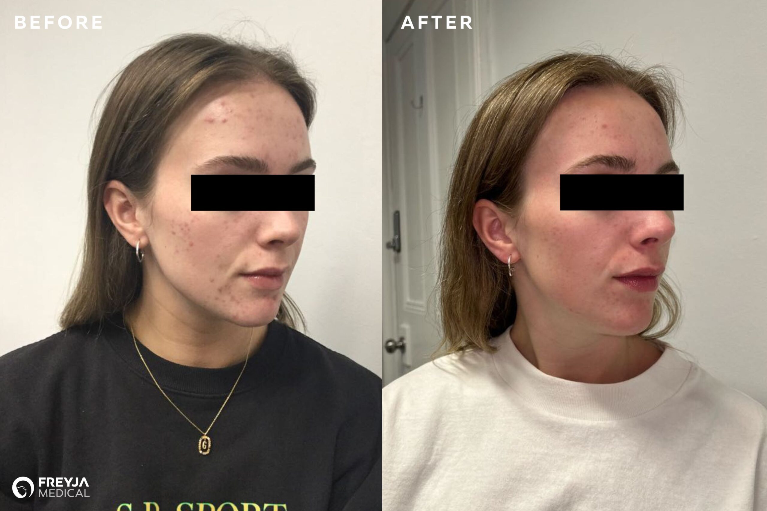 Skin Peels at Freyja Medical. Results. Before and After Images