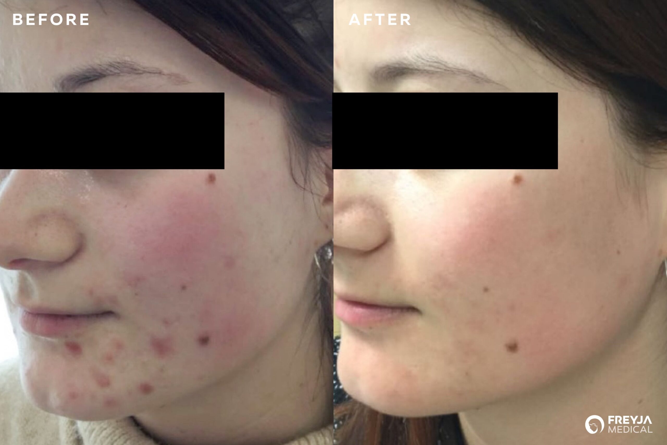 Chemical Peel treatments at Freyja Medical. Results. Before and After Images