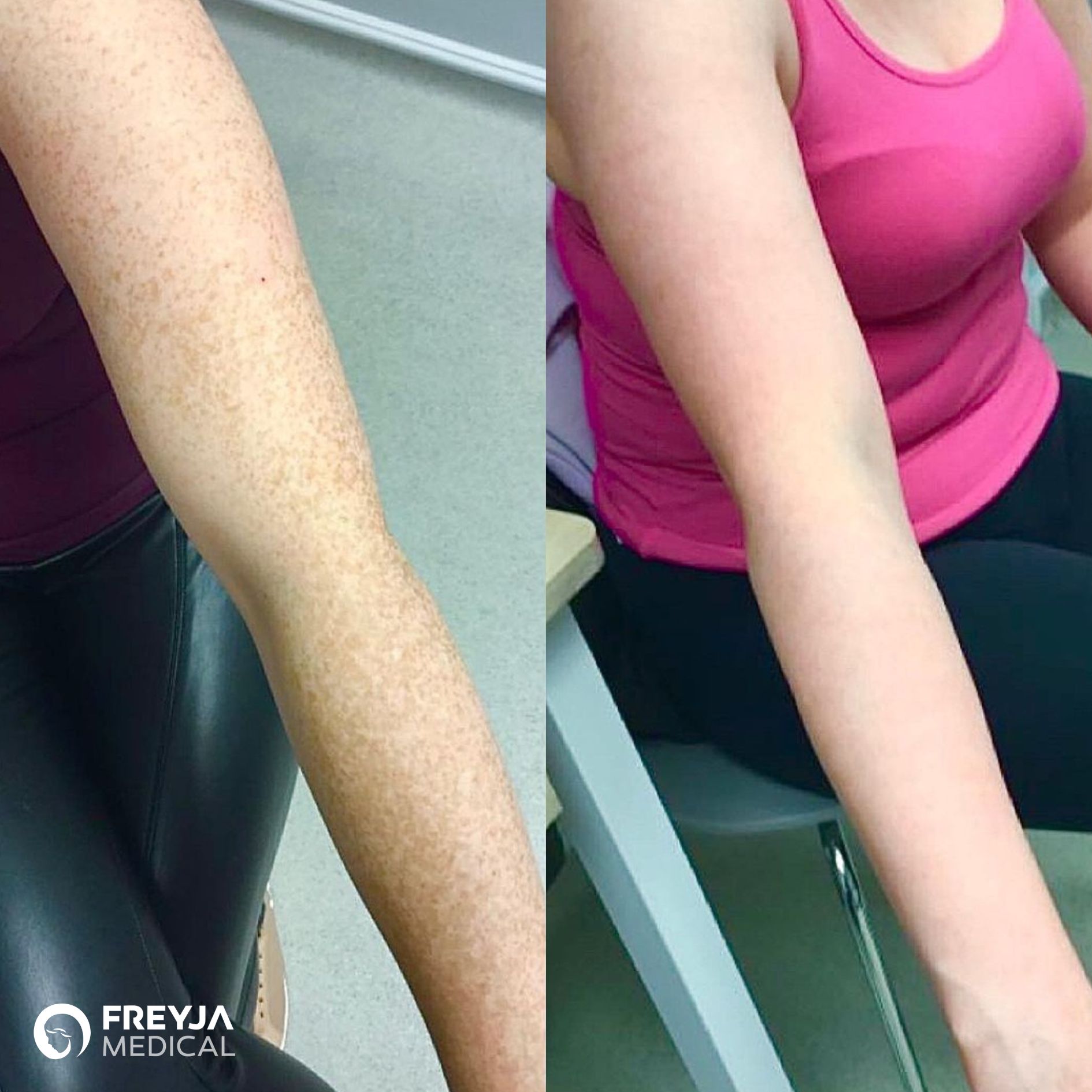 Uneven Skin Tone / Pigmentation, before and after IPL treatment at Freyja Medical