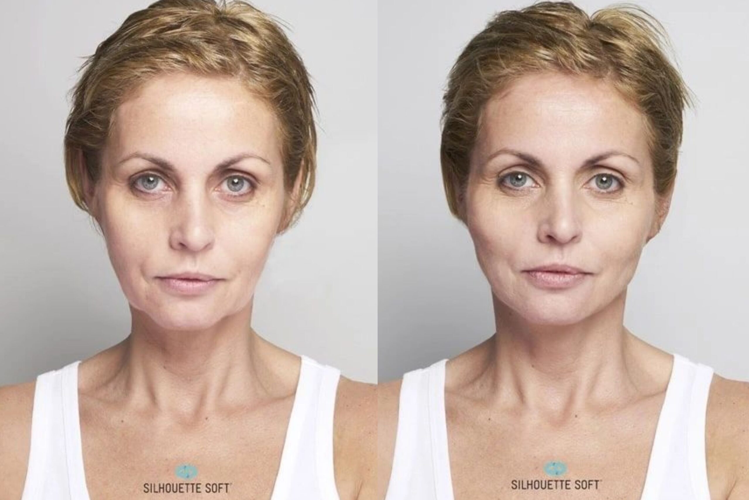 Silhouette Soft thread lifts results, before and after image
