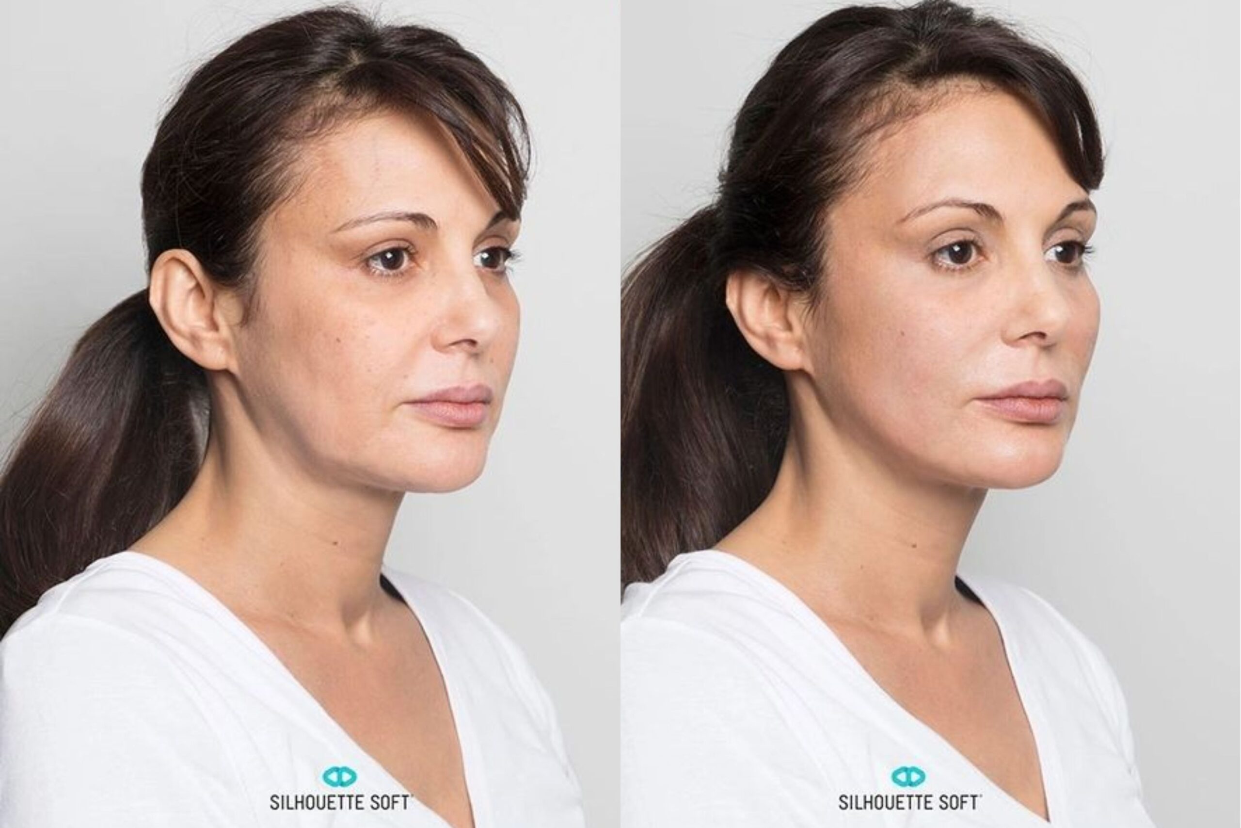 Silhouette Soft Thread Lifts: Before and After Image