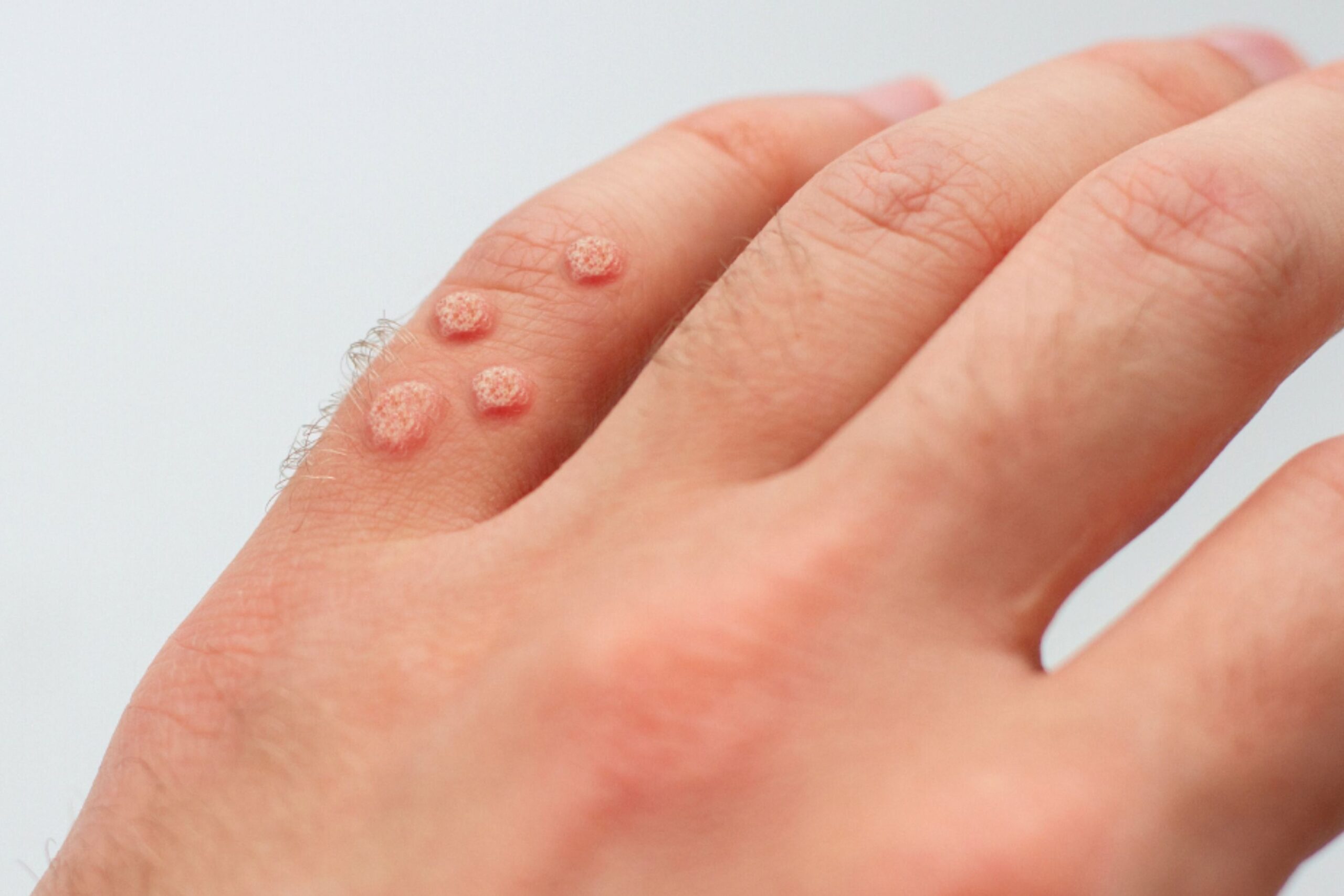 Warts and Verrucas Treatments