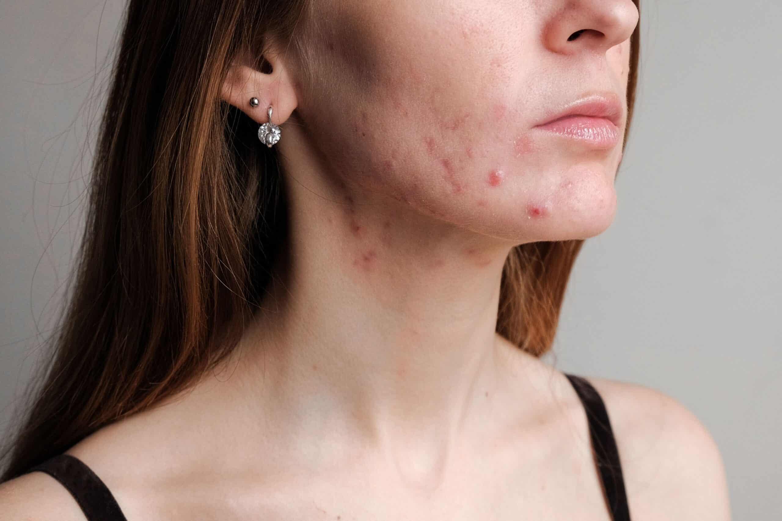 Acne scars treatments at Freyja Medical in Wrexham, Nantwich and Cheshire
