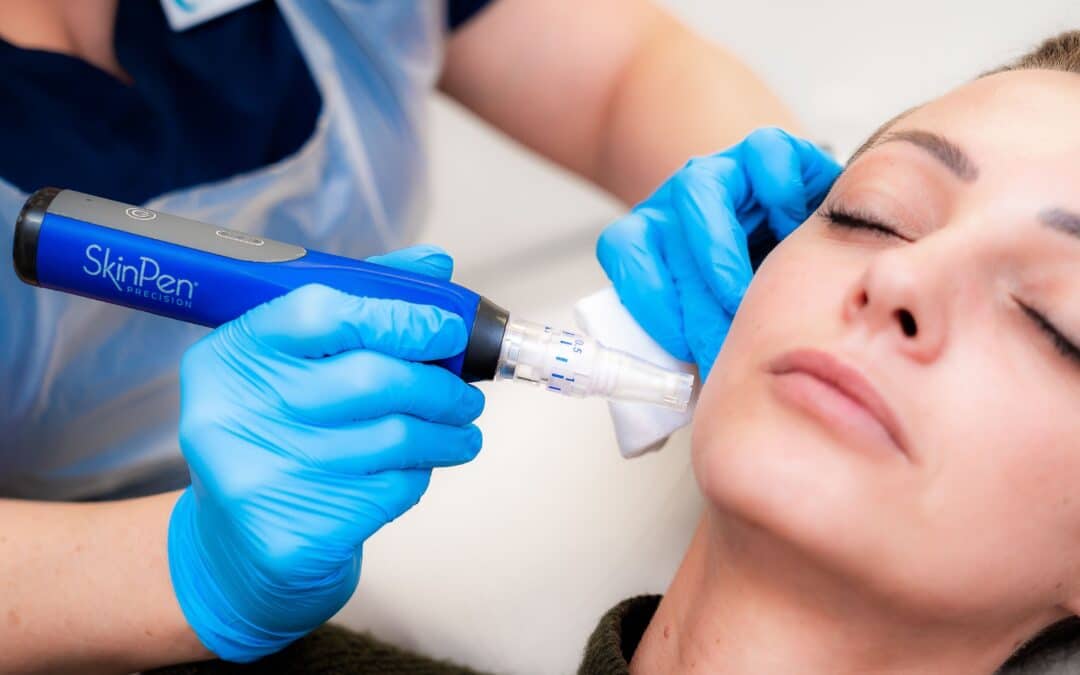 Microneedling with PRP for Acne Scarring: How It Works