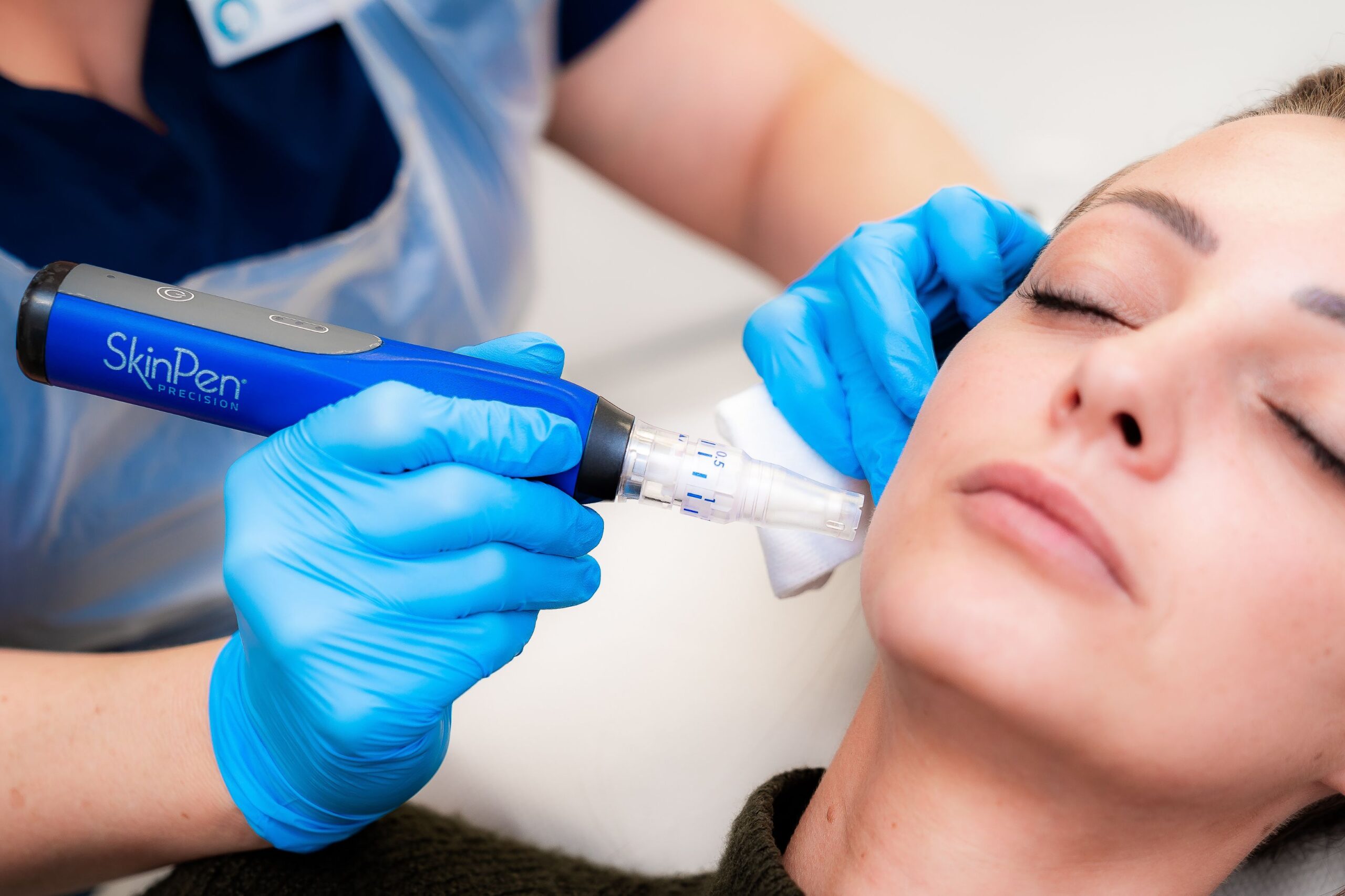 Microneedling for acne scars at Freyja Medical in Wrexham, Nantwich and Cheshire 
