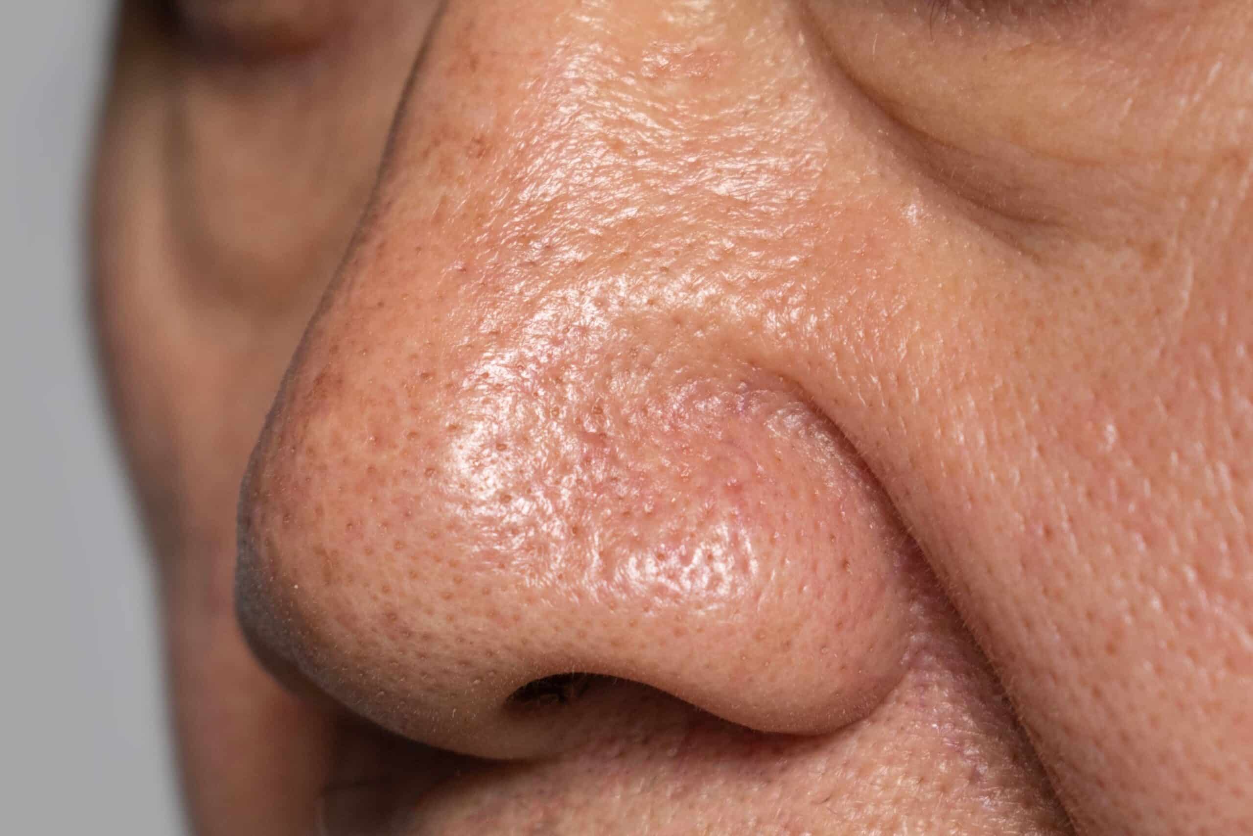 Red Nose Enlarged Pores