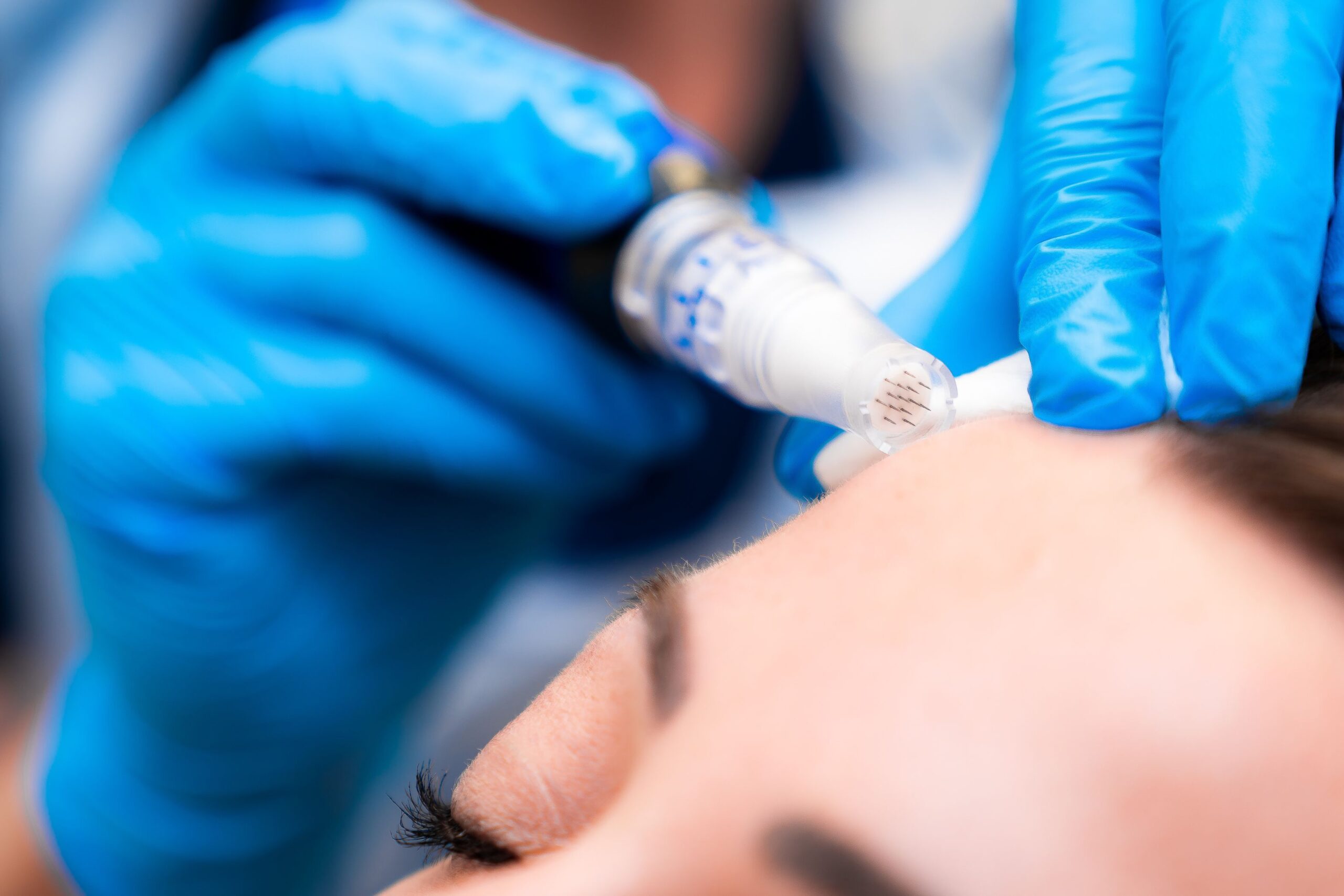 Microneedling for acne scars at Freyja Medical in Wrexham, Nantwich and Cheshire