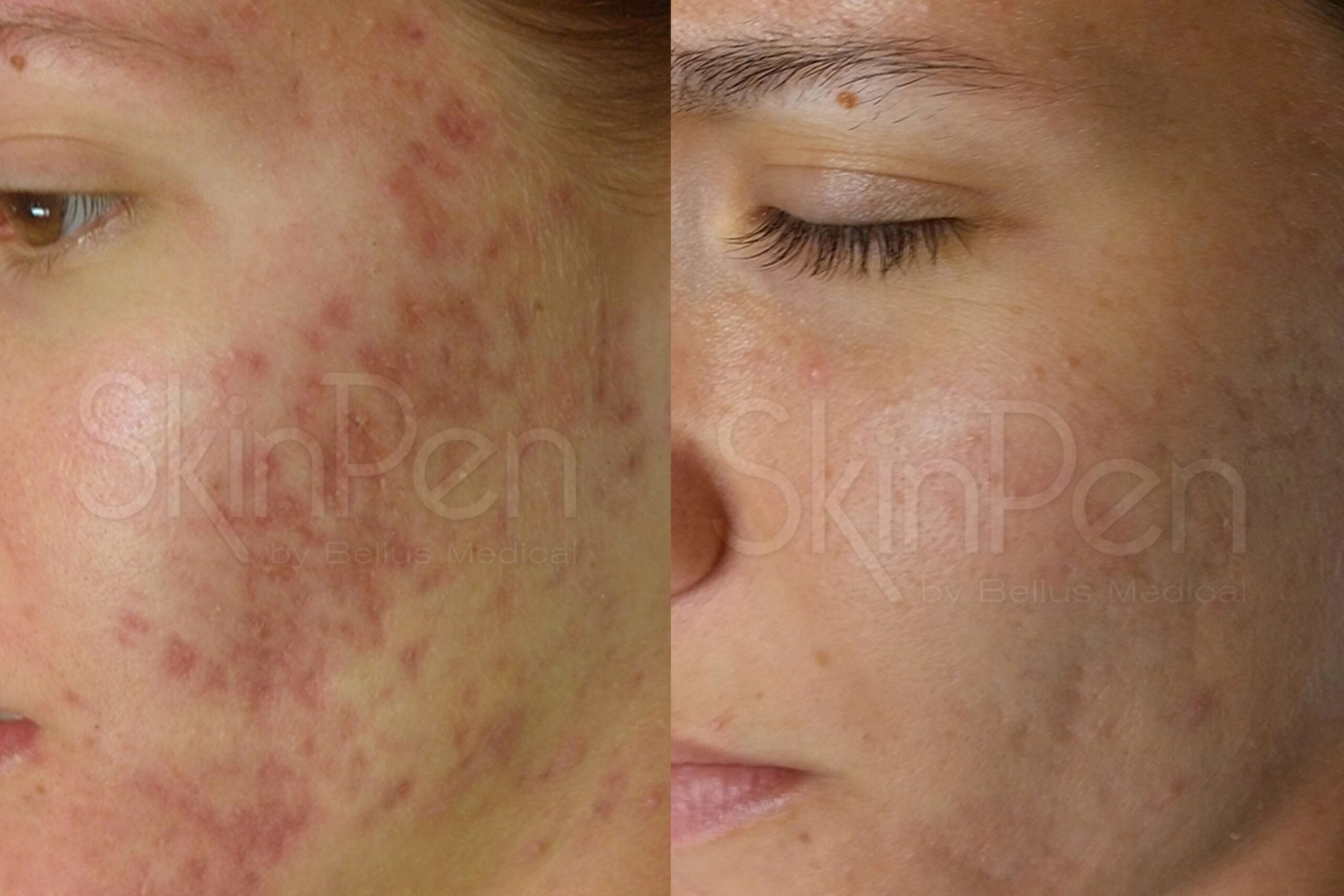 Treatments for acne scarring at Freyja Medical in Wrexham, Nantwich and Cheshire
