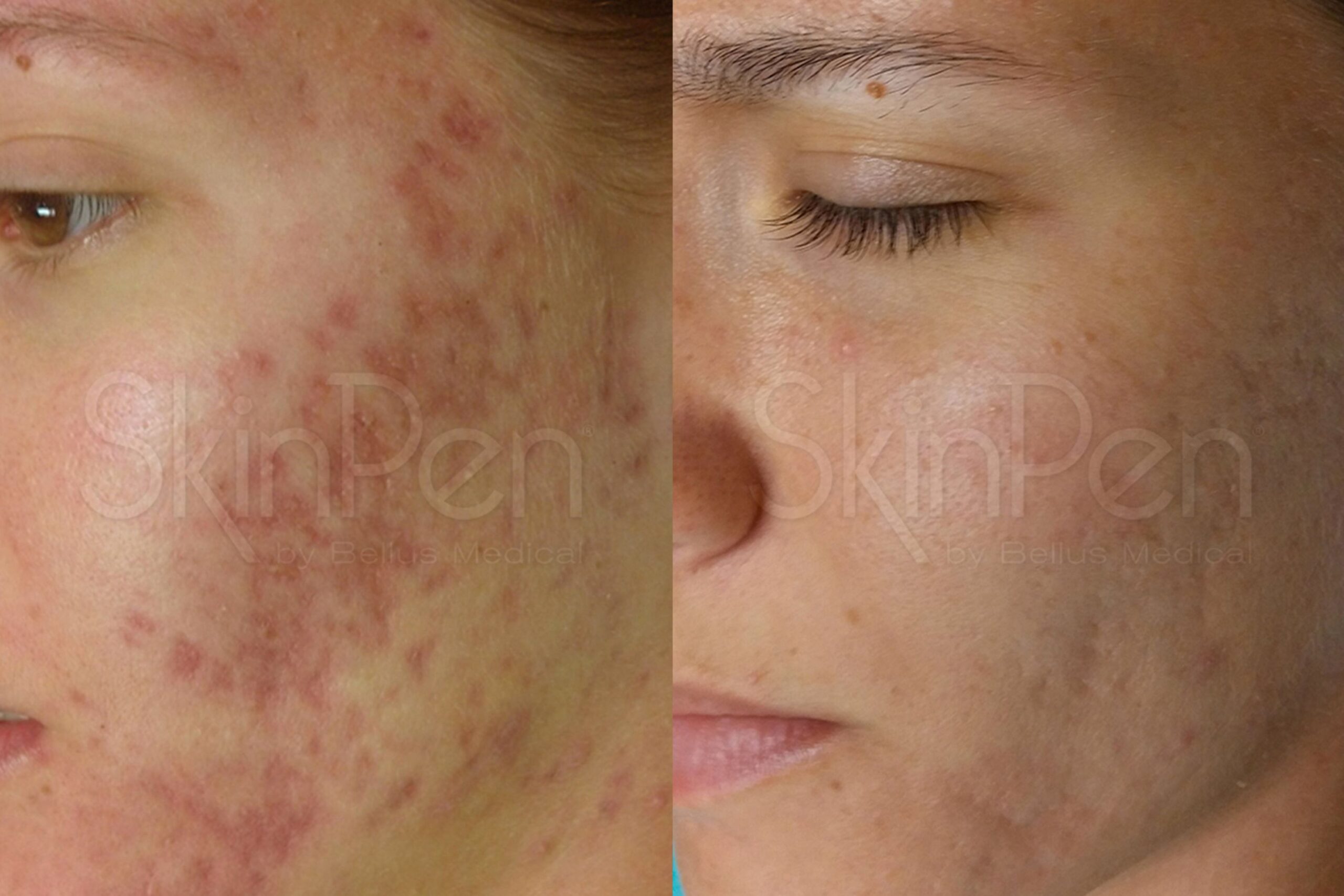 SkinPen Microneedling for Acne Scaring, Before and After Image