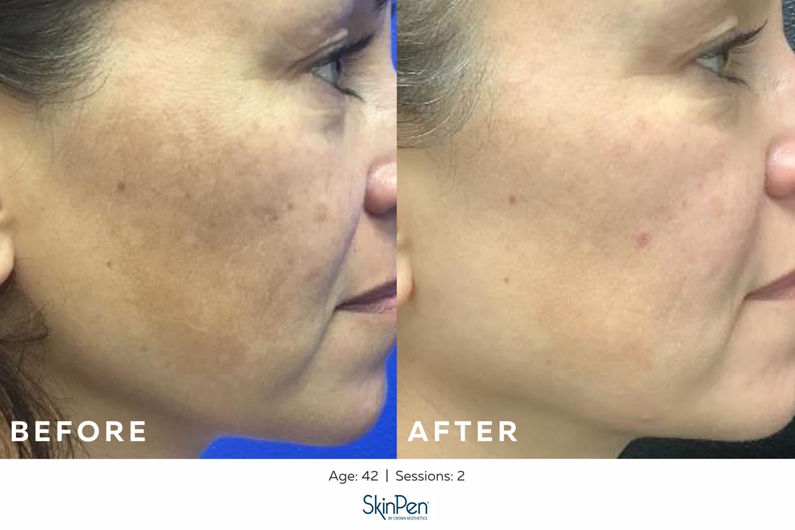 SkinPen Microneedling for Pigmentation, Before and After Image