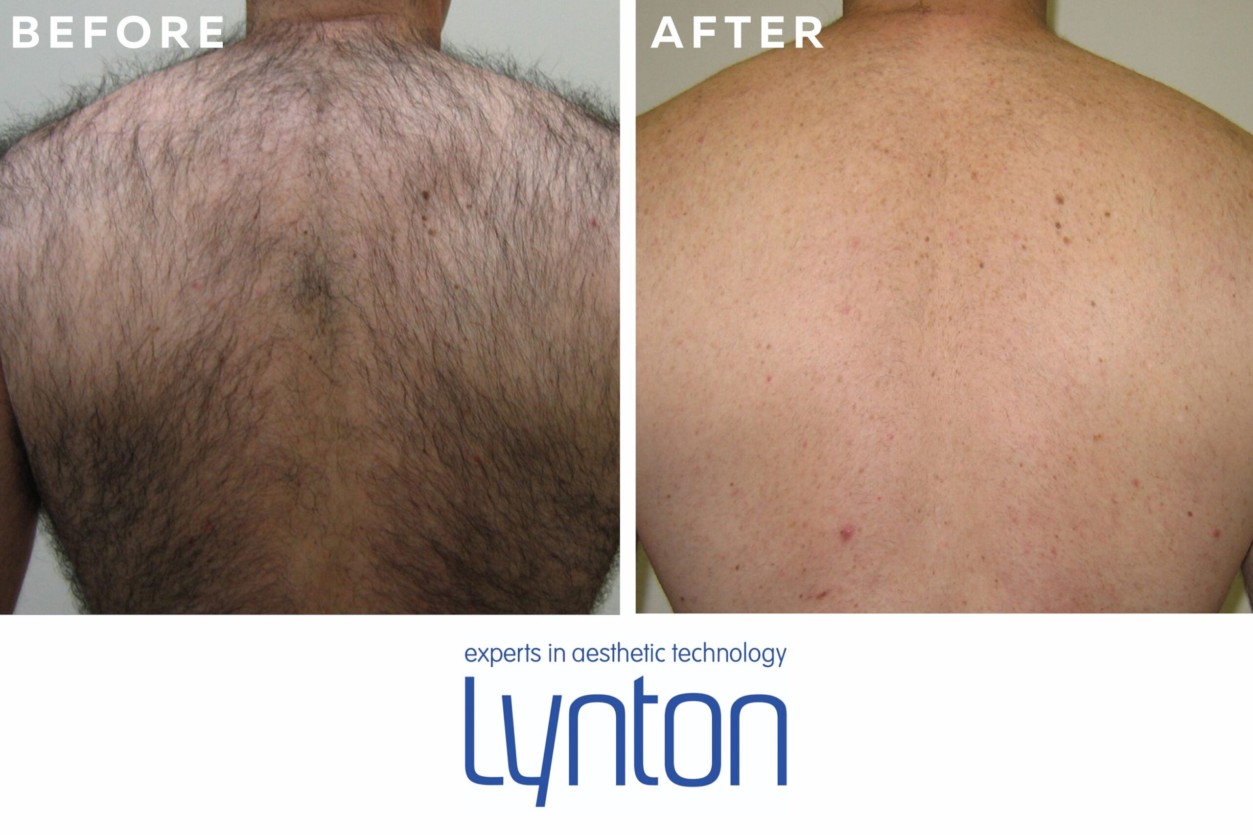 IPL Hair Removal, Back Hair Results, Before and After Images