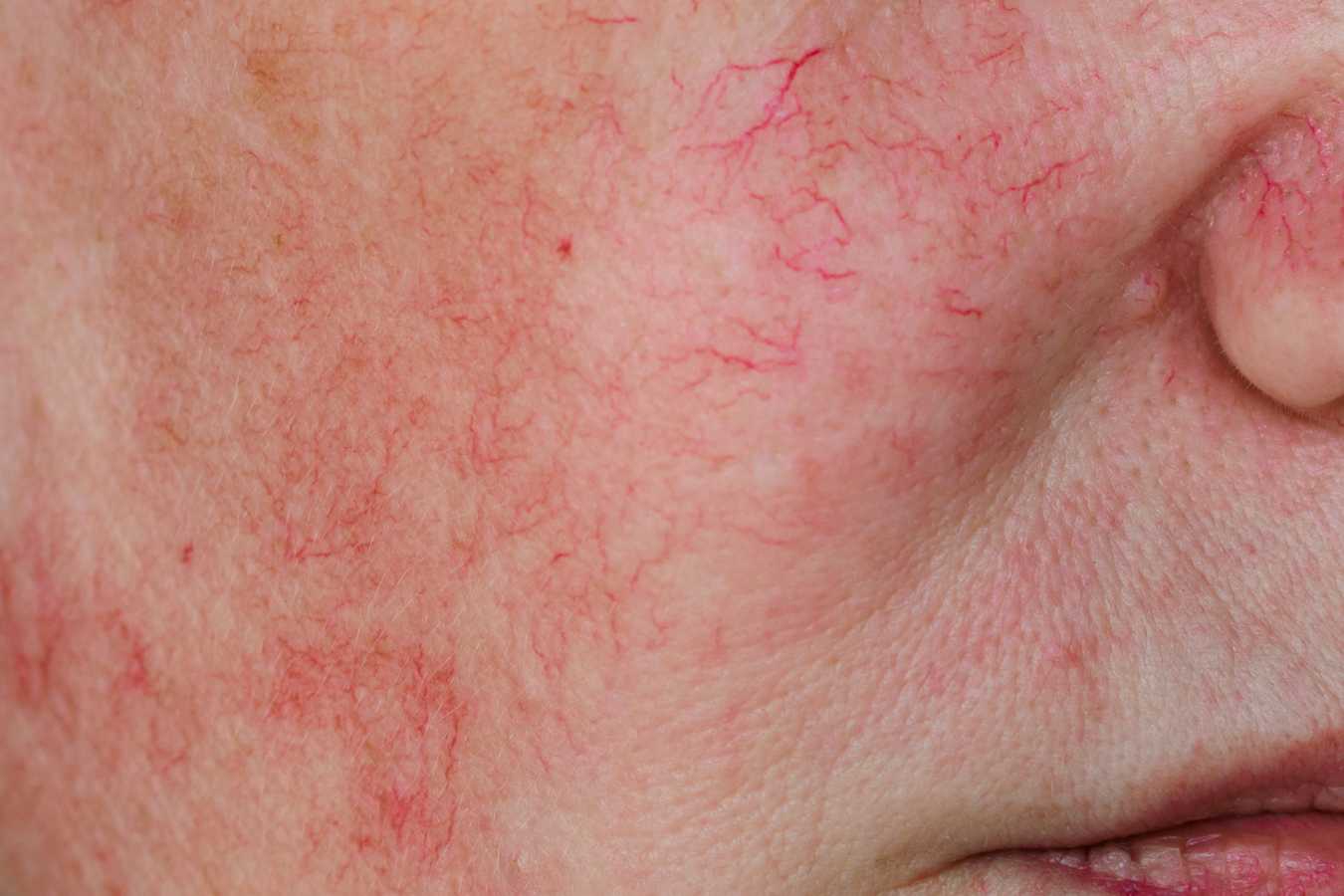 Spider Veins / Thread Veins