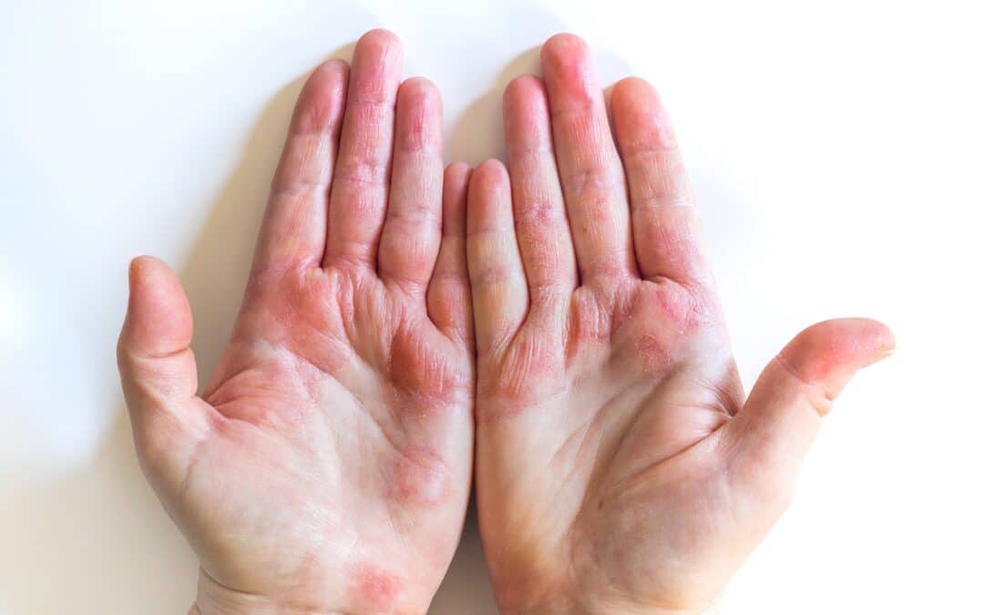 Eczema vs Psoriasis: How to Tell the Difference