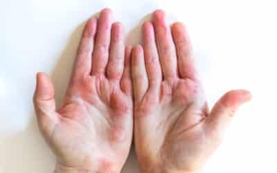 Eczema vs Psoriasis: How to Tell the Difference