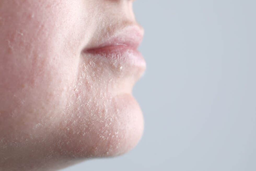 Skin Inconsistence Uneven Skin Texture - Freyja Medical