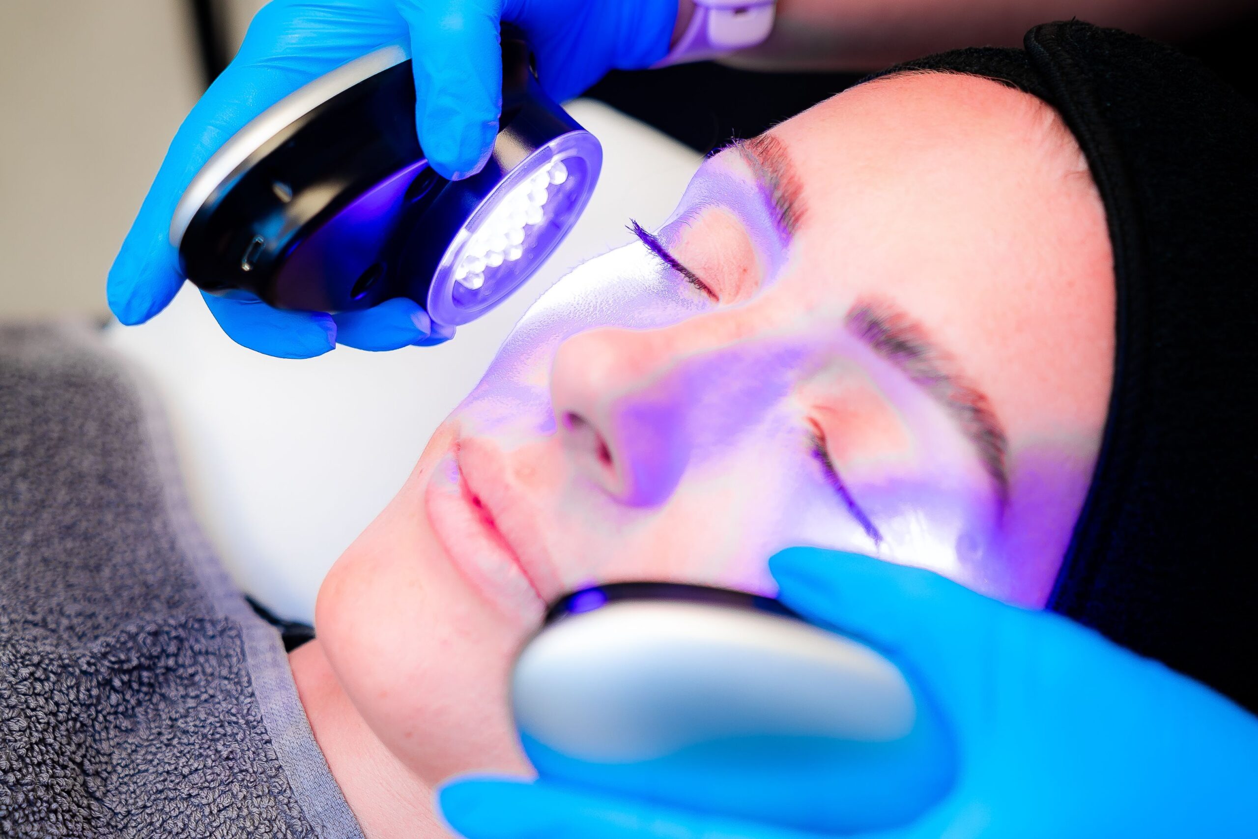 Photofacial for Acne at Freyja Medical in Wrexham, Nantwich and Cheshire