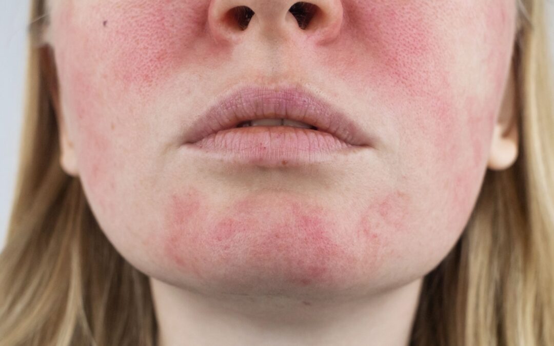 Rosacea