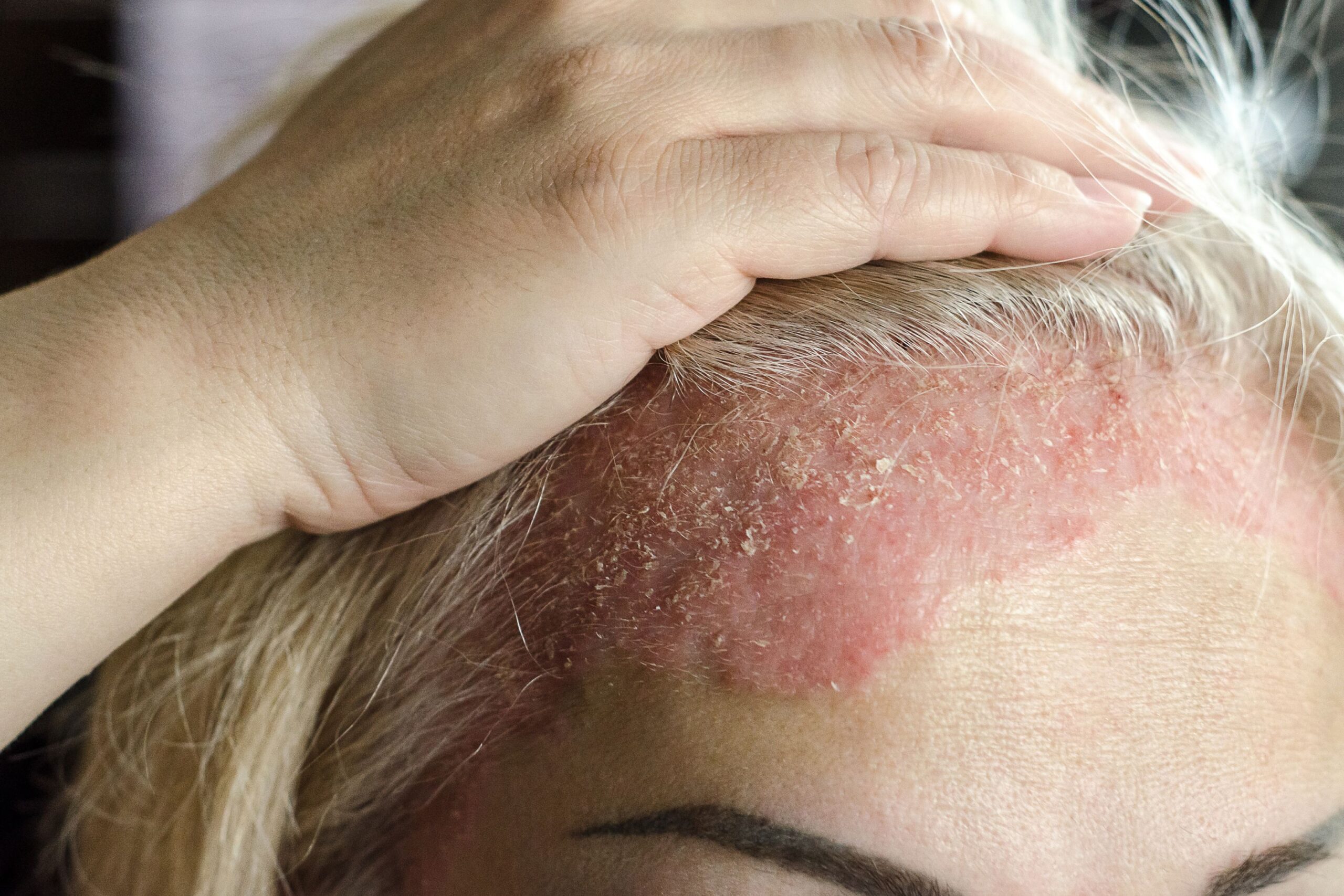 Psoriasis treatments at Freyja Medical in Wrexham, Nantwich and Cheshire