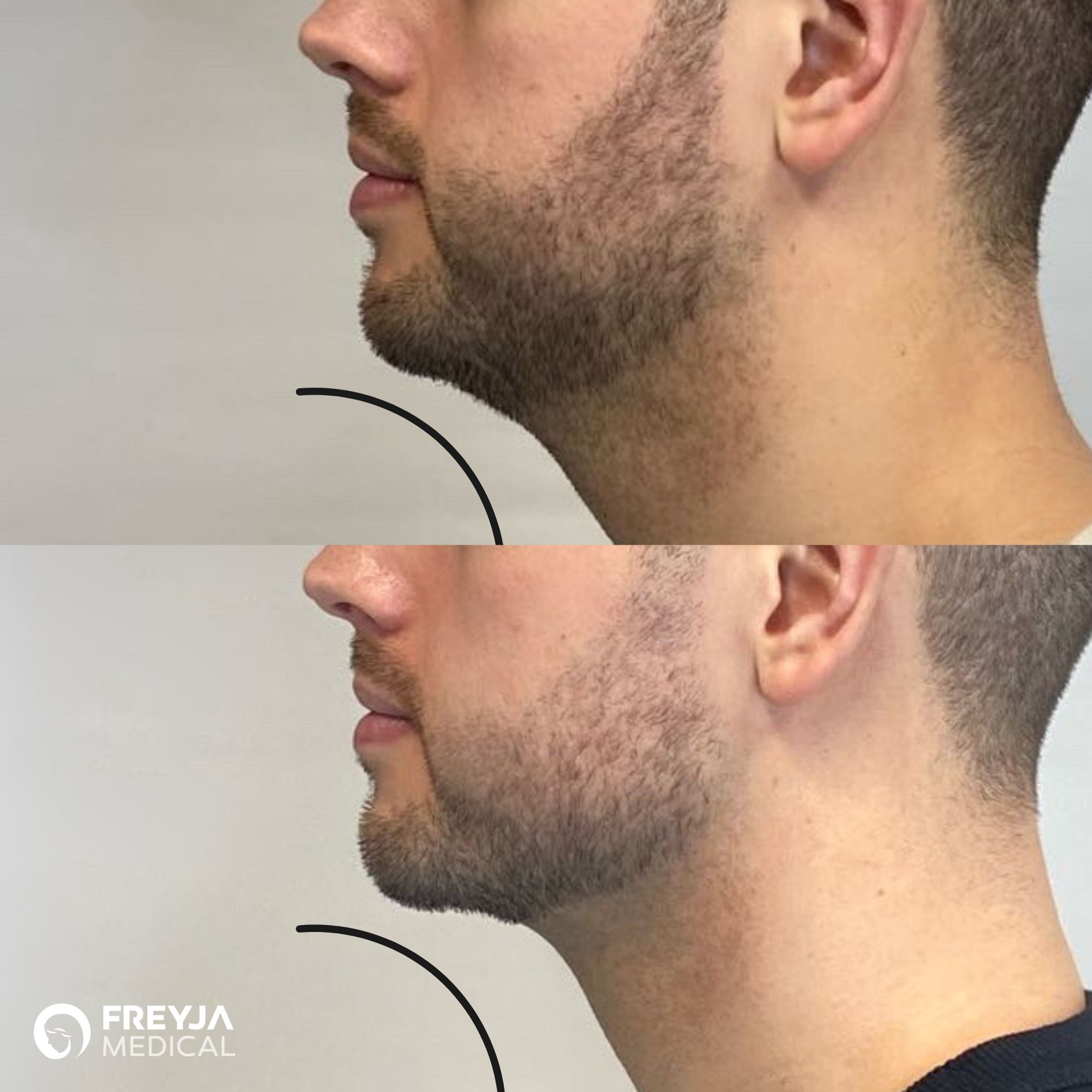 Fat-dissolving treatment for double chin at Freyja Medical in Wrexham, Nantwich and Cheshire