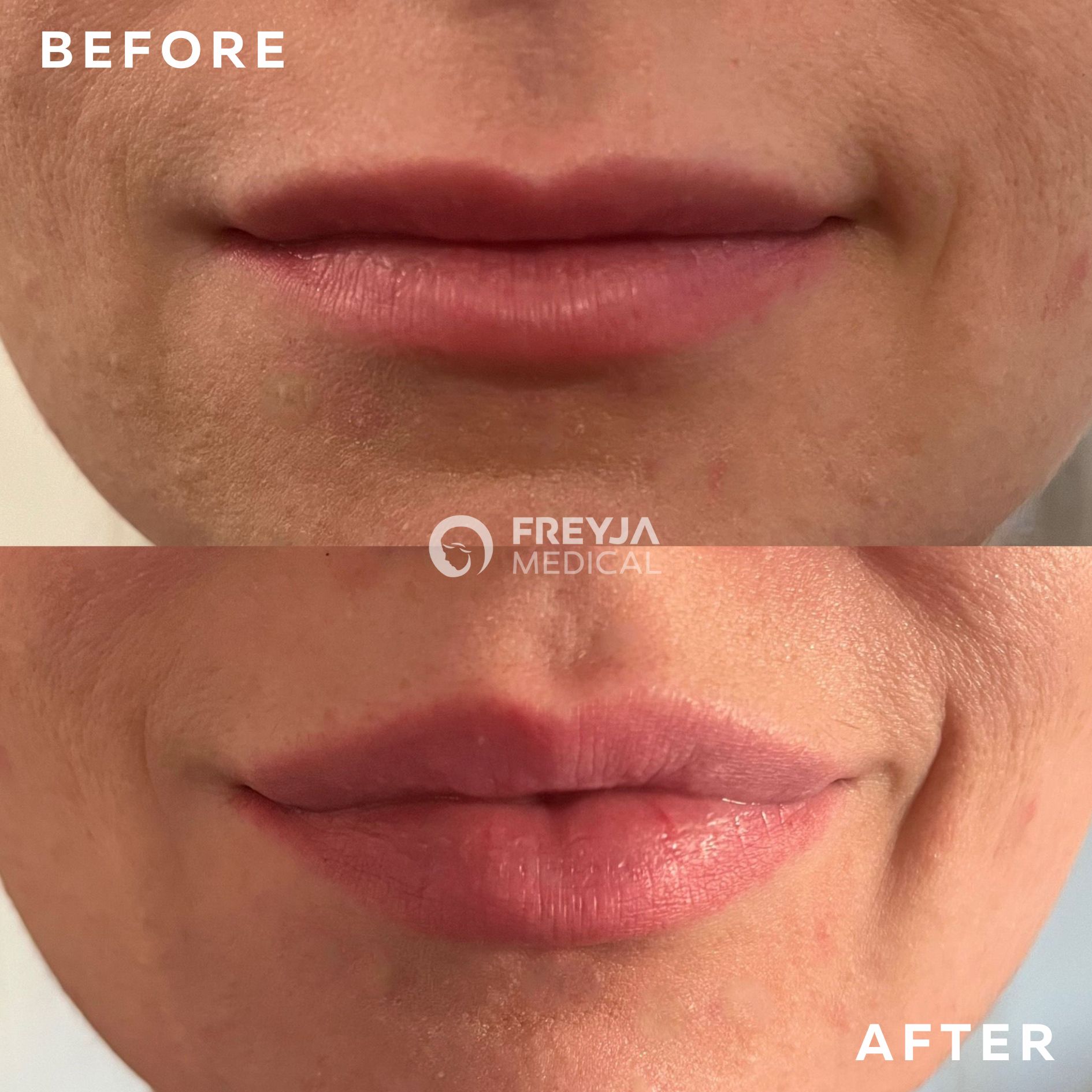 Dermal fillers for thin lips at Freyja Medical in Wrexham, Nantwich and Cheshire