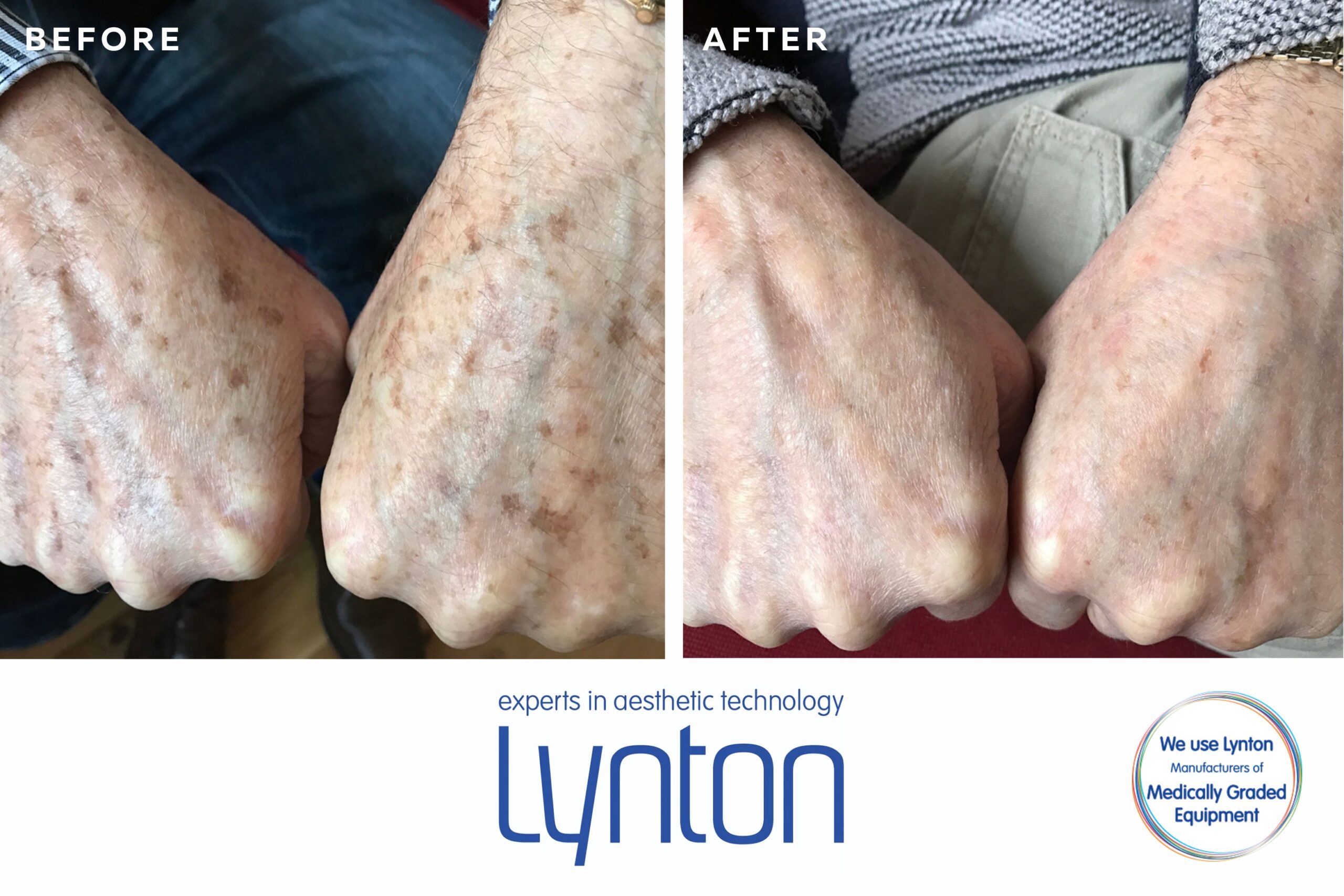 Results from IPL Treatment with the Lynton Excelight: Removing Dark Spots from Ageing Hands