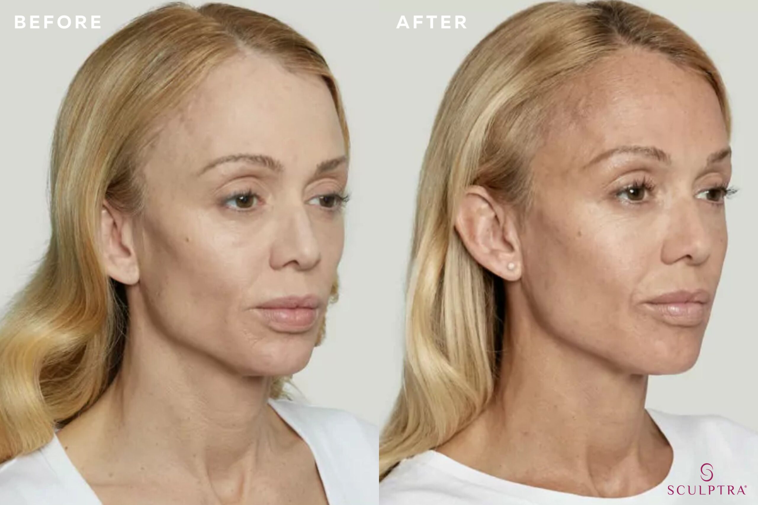 Results from Sculptra treatment for hollow / sunken cheeks