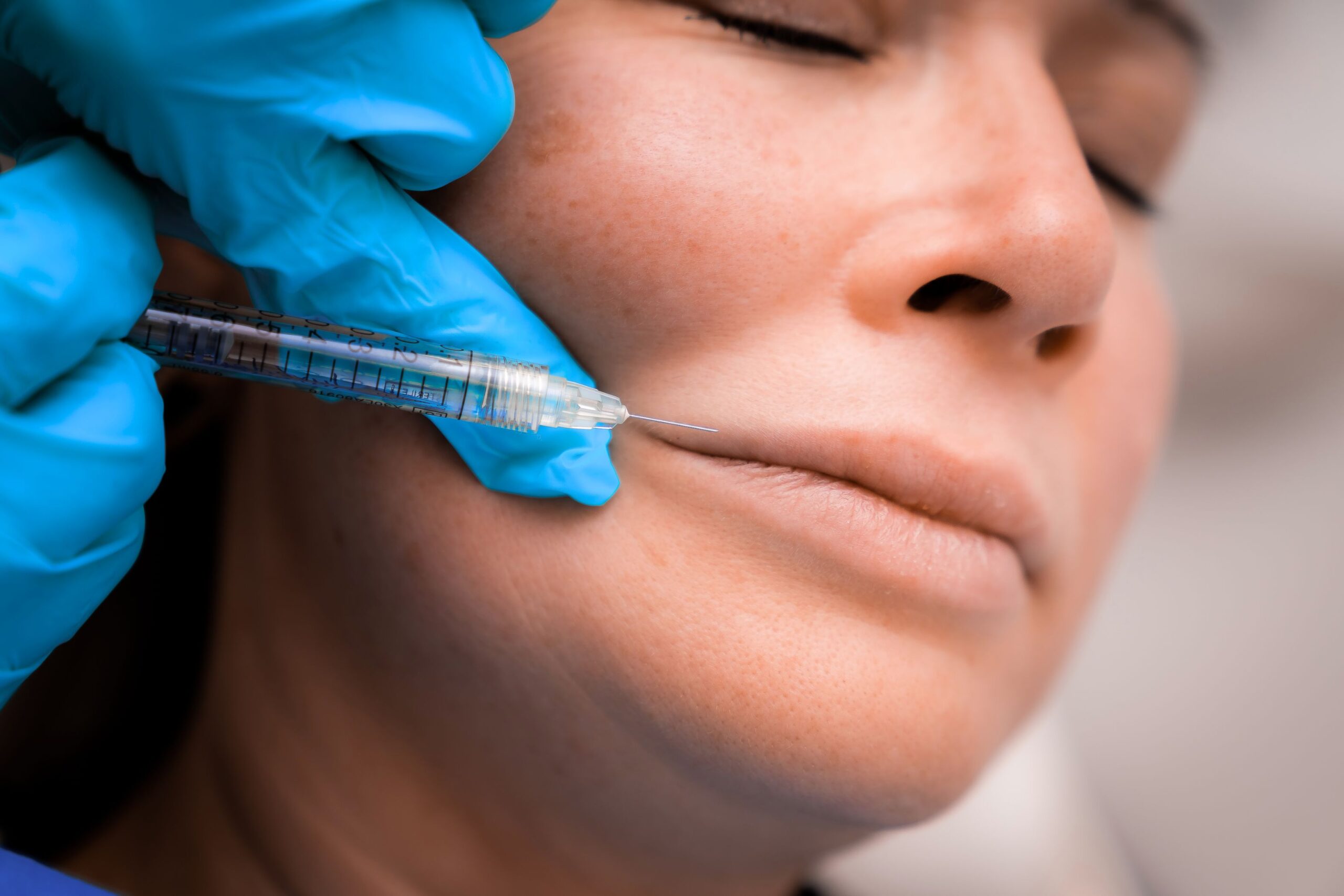 Dermal fillers for uneven lip shape at Freyja Medical in Wrexham, Nantwich and Cheshire