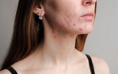Teenage Pimples and Acne: Top Treatments and Expert Skincare