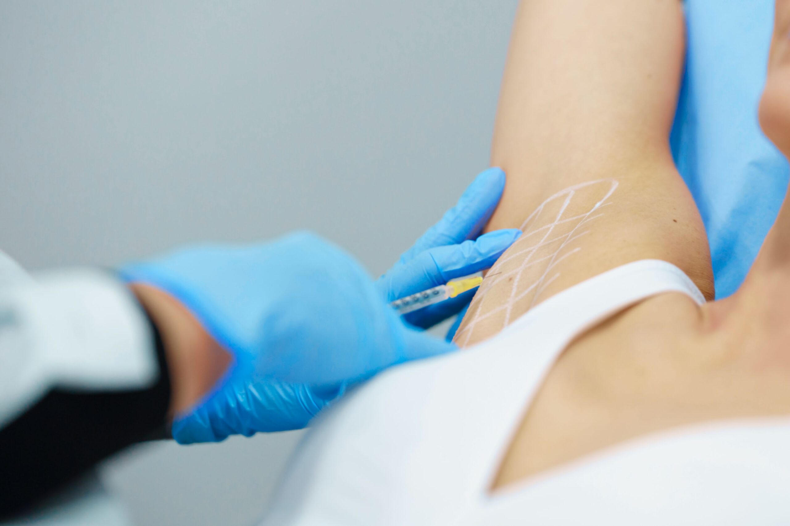 Muscle relaxing injections for excessive sweating at Freyja Medical in Wrexham, Nantwich and Cheshire