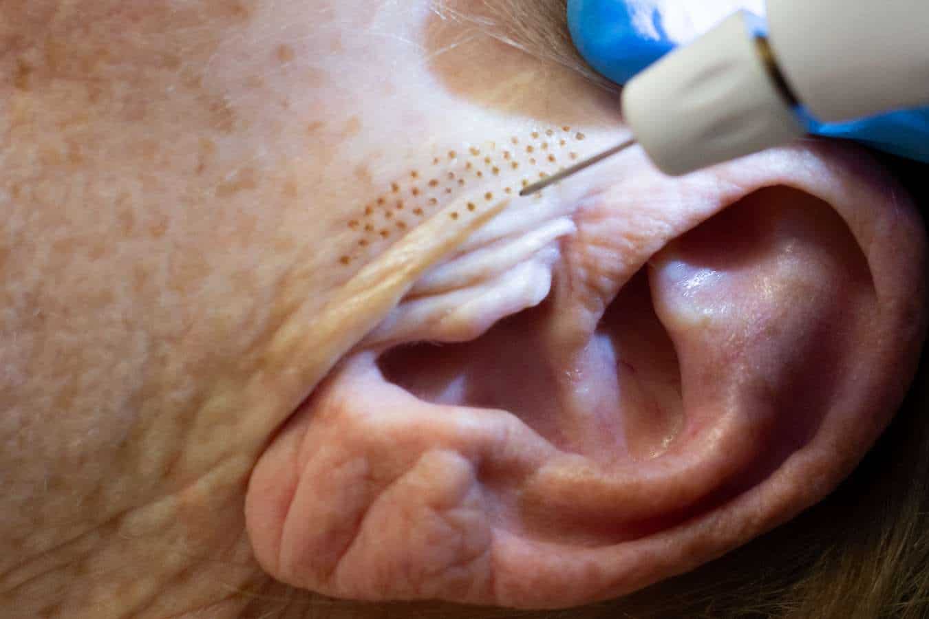 Plexr Plus for ageing neck at Freyja Medical in Wrexham, Nantwich and Cheshire