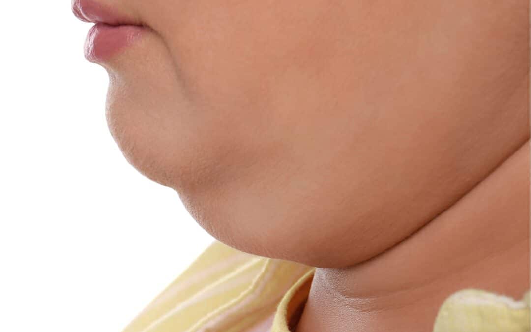 Thin With Double Chin: Why It Happens and What Can Help