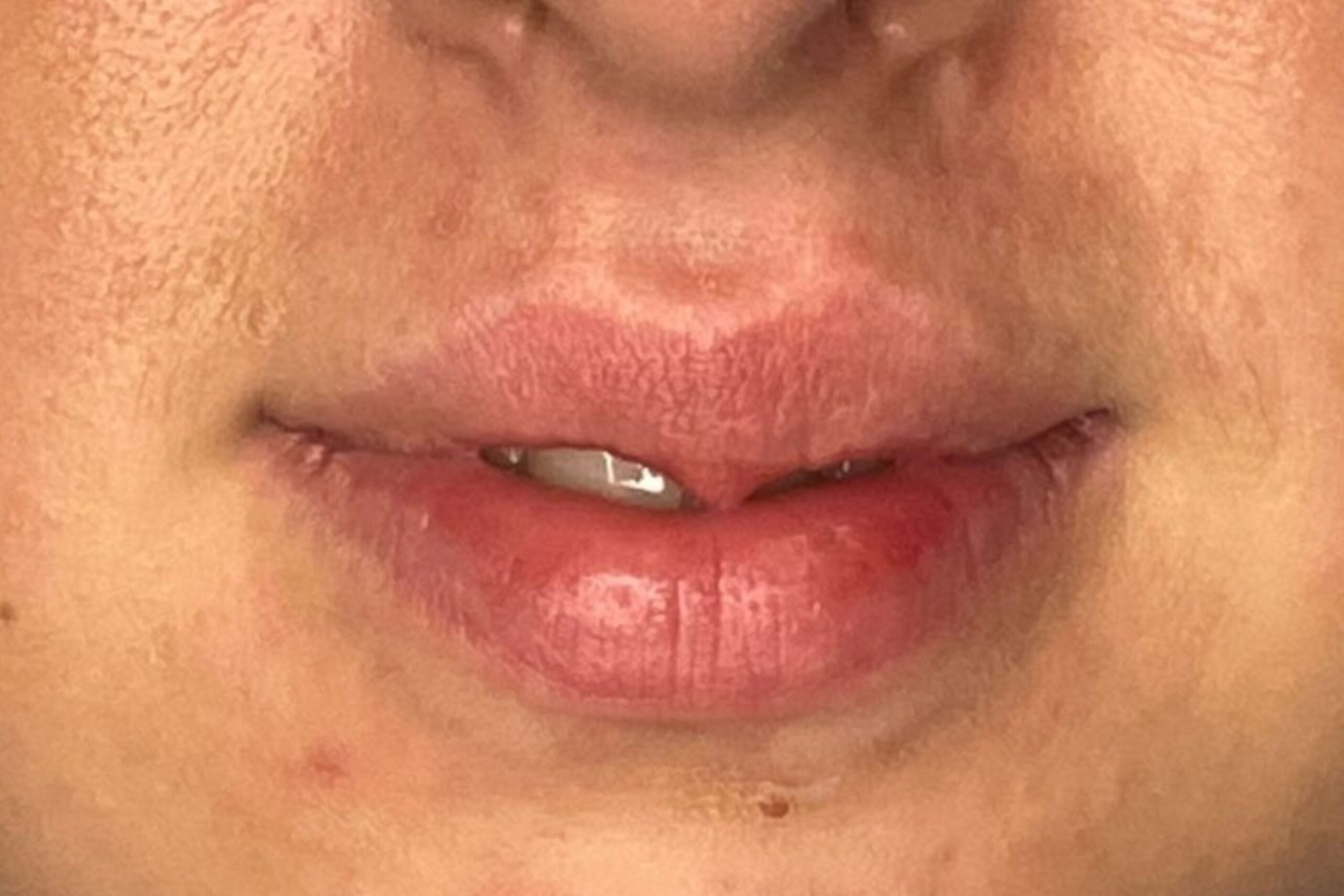 Uneven Lip Shape - Freyja Medical