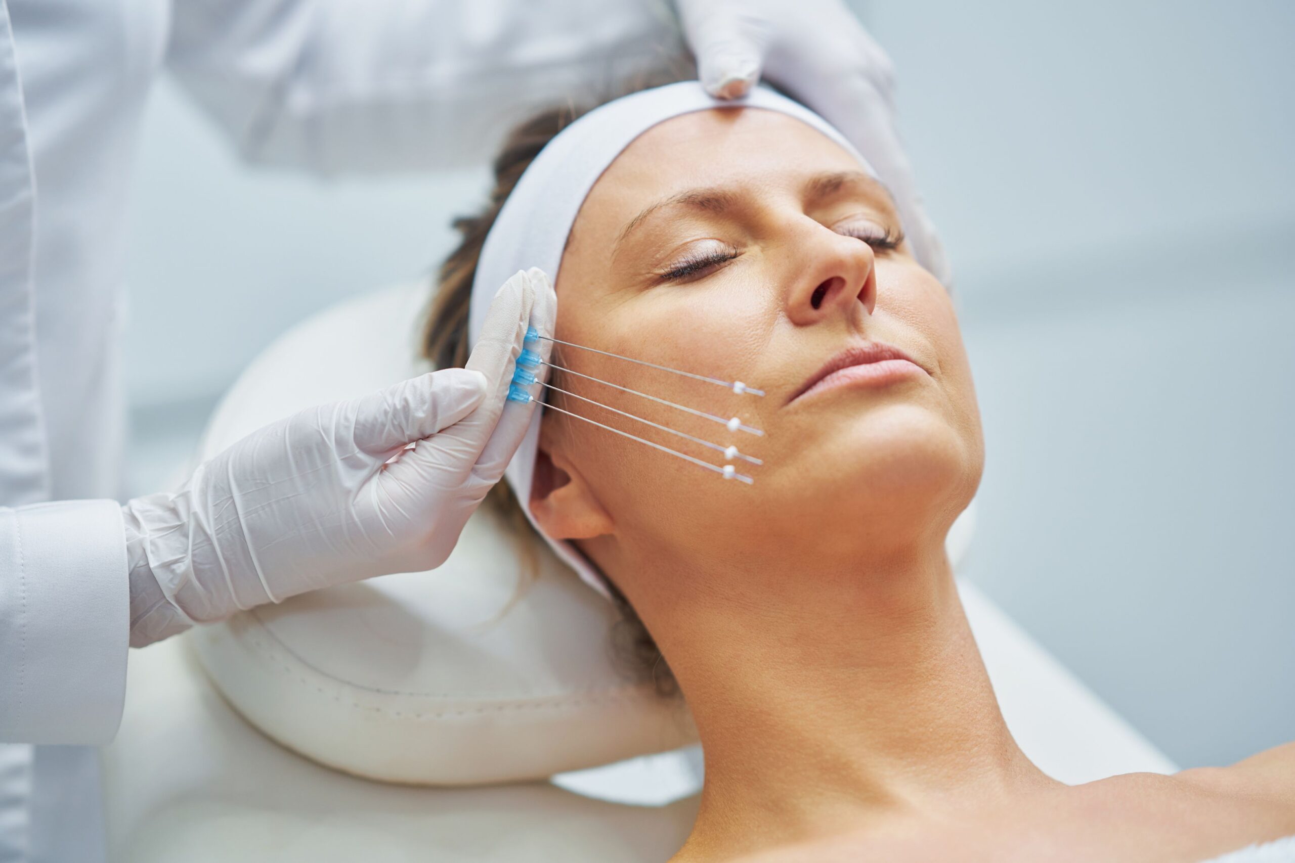 Thread Lift for neck lines at Freyja Medical in Wrexham, Nantwich and Cheshire