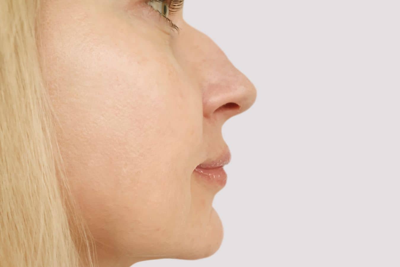 Nose Bump / Dorsal Hump