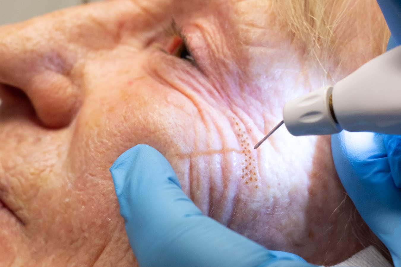 Plexr for drooping eyelids at Freyja Medical in Wrexham, Nantwich and Cheshire