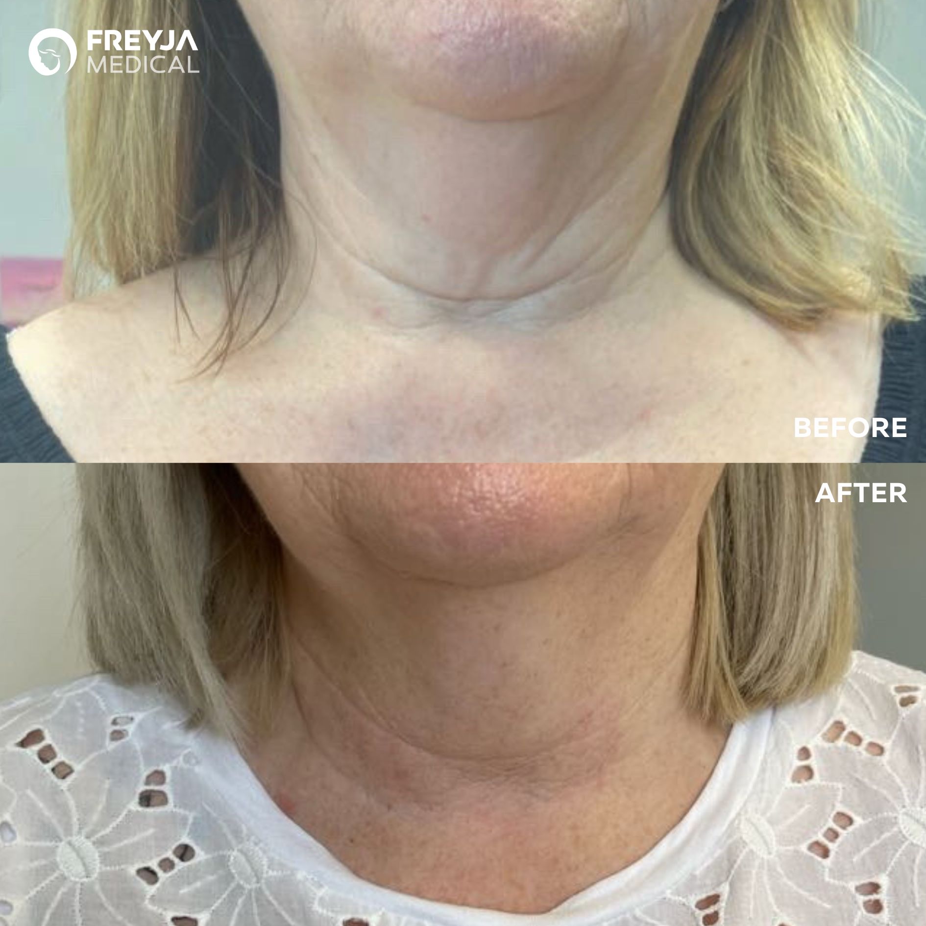 Neck Lines before and after Plexr treatment at Freyja Medical in Wrexham, Nantwich and Cheshire