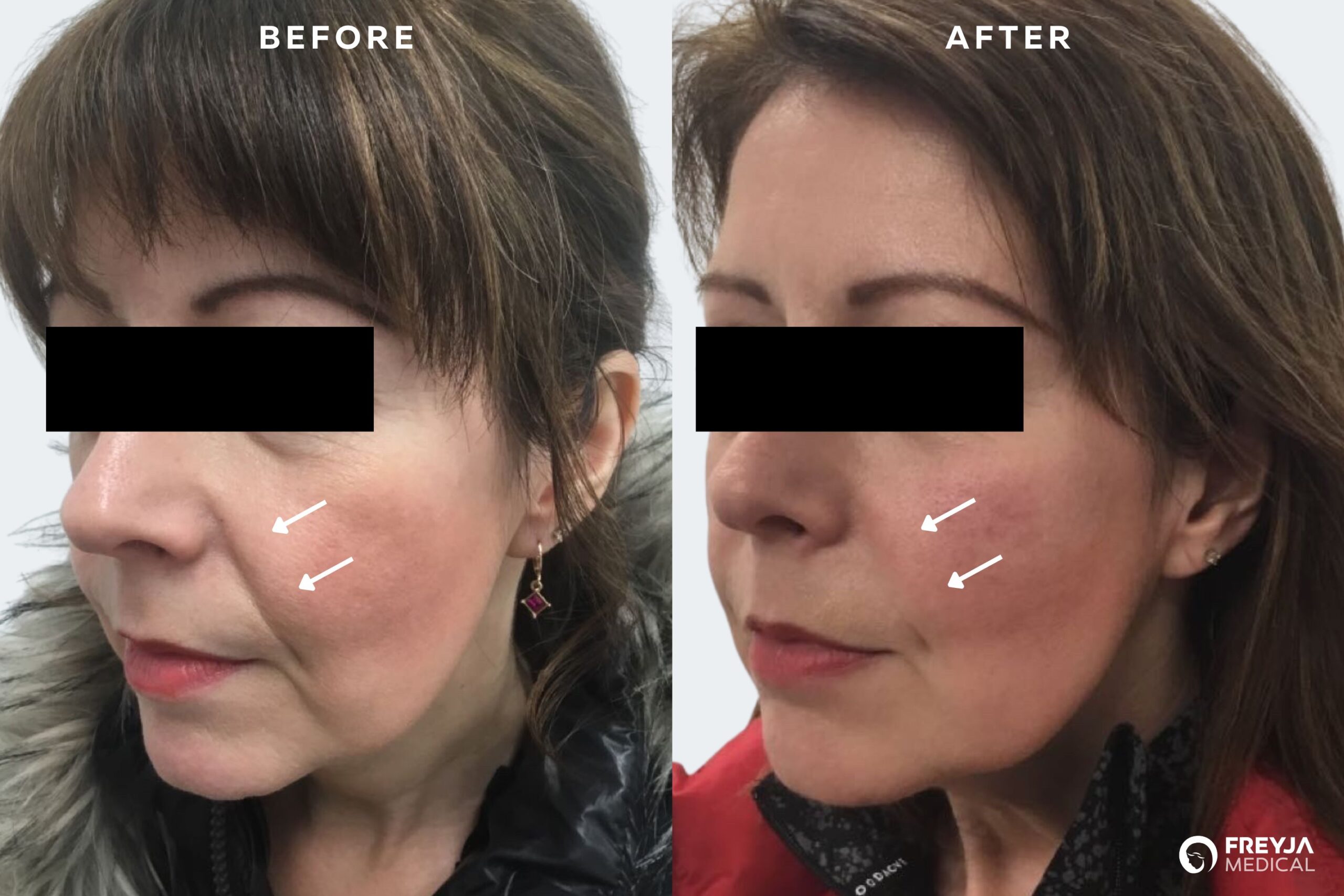 Nasolabial folds / smile lines before and after dermal fillers treatment at Freyja Medical in Wrexham, Nantwich and Cheshire