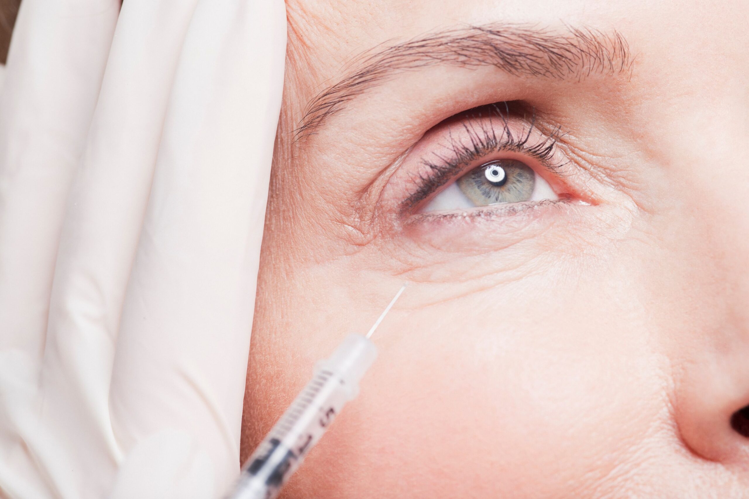 Dermal fillers for dark circles at Freyja Medical in Wrexham, Nantwich and Cheshire
