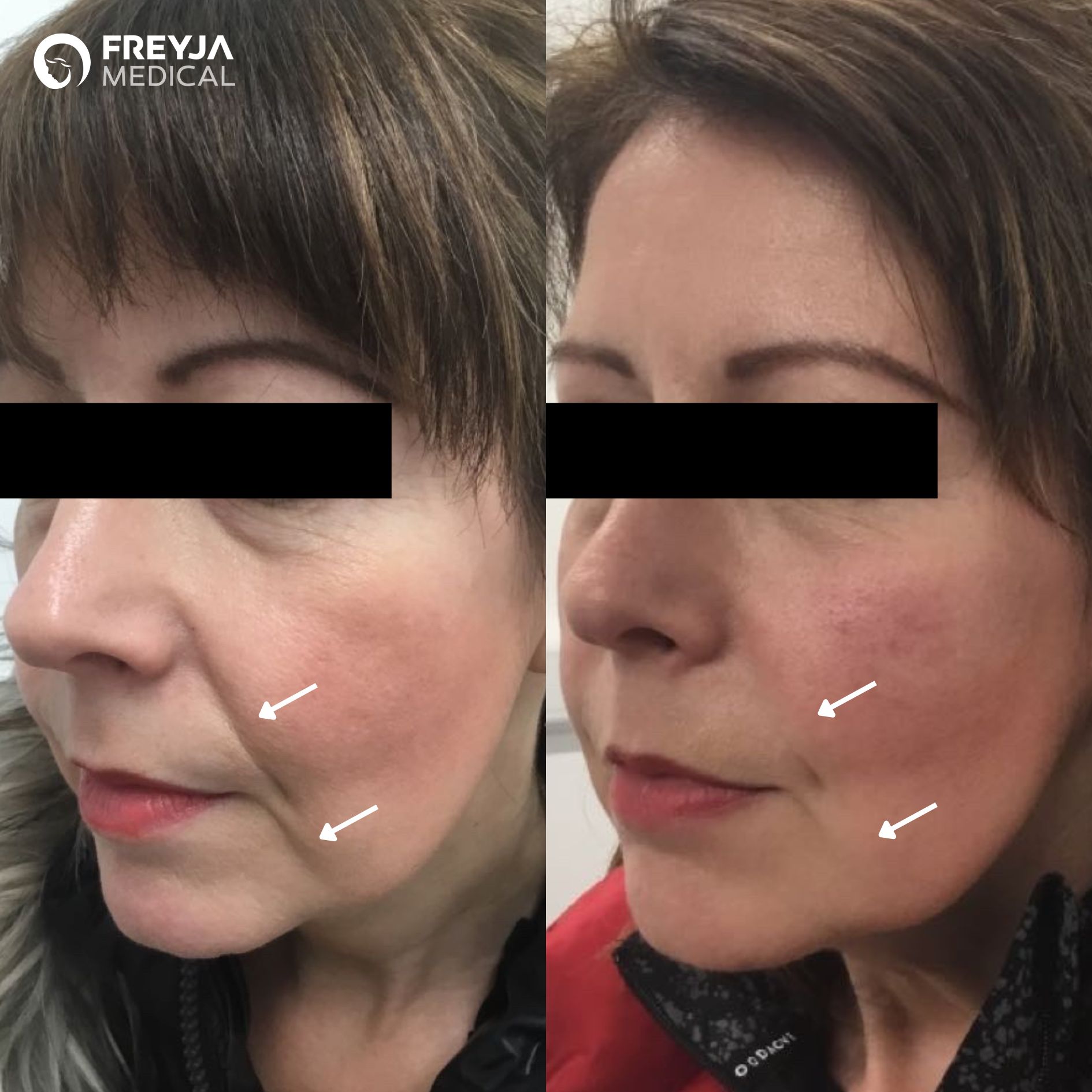 Marionette lines and Nasolabial Folds before and after dermal fillers treatment at Freyja Medical in Wrexham, Nantwich and Cheshire