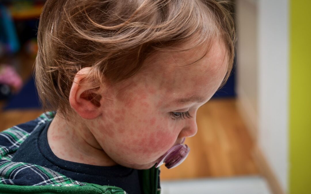 Childhood Rashes: When to Seek a Dermatologist