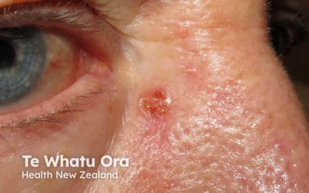 Basal Cell Skin Cancer on the Nose: Symptoms and Treatment