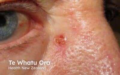 Basal Cell Skin Cancer on the Nose: Symptoms and Treatment